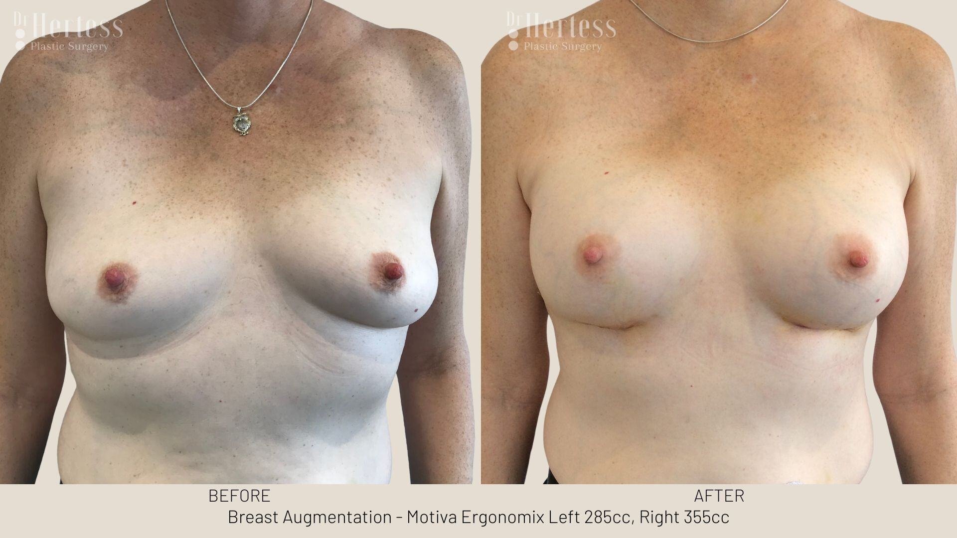 breast aug photos before and after