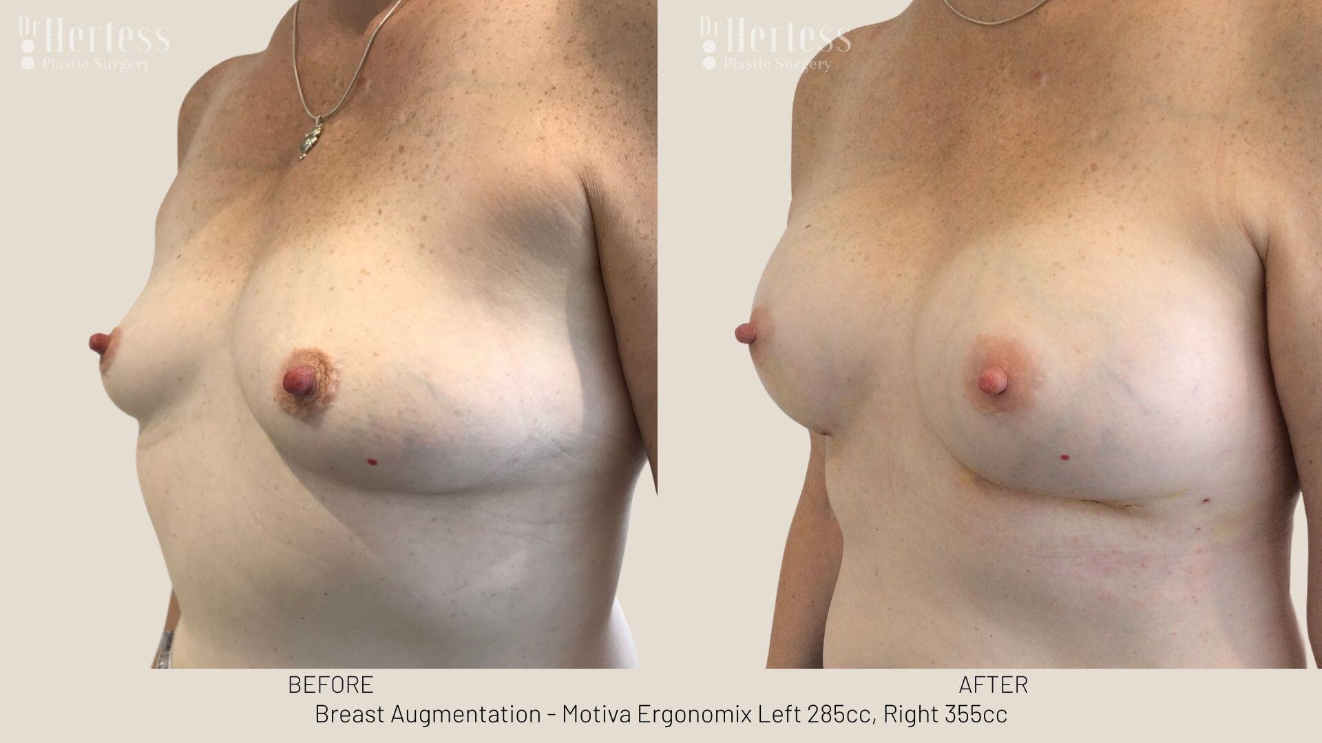 breast aug photos before and after