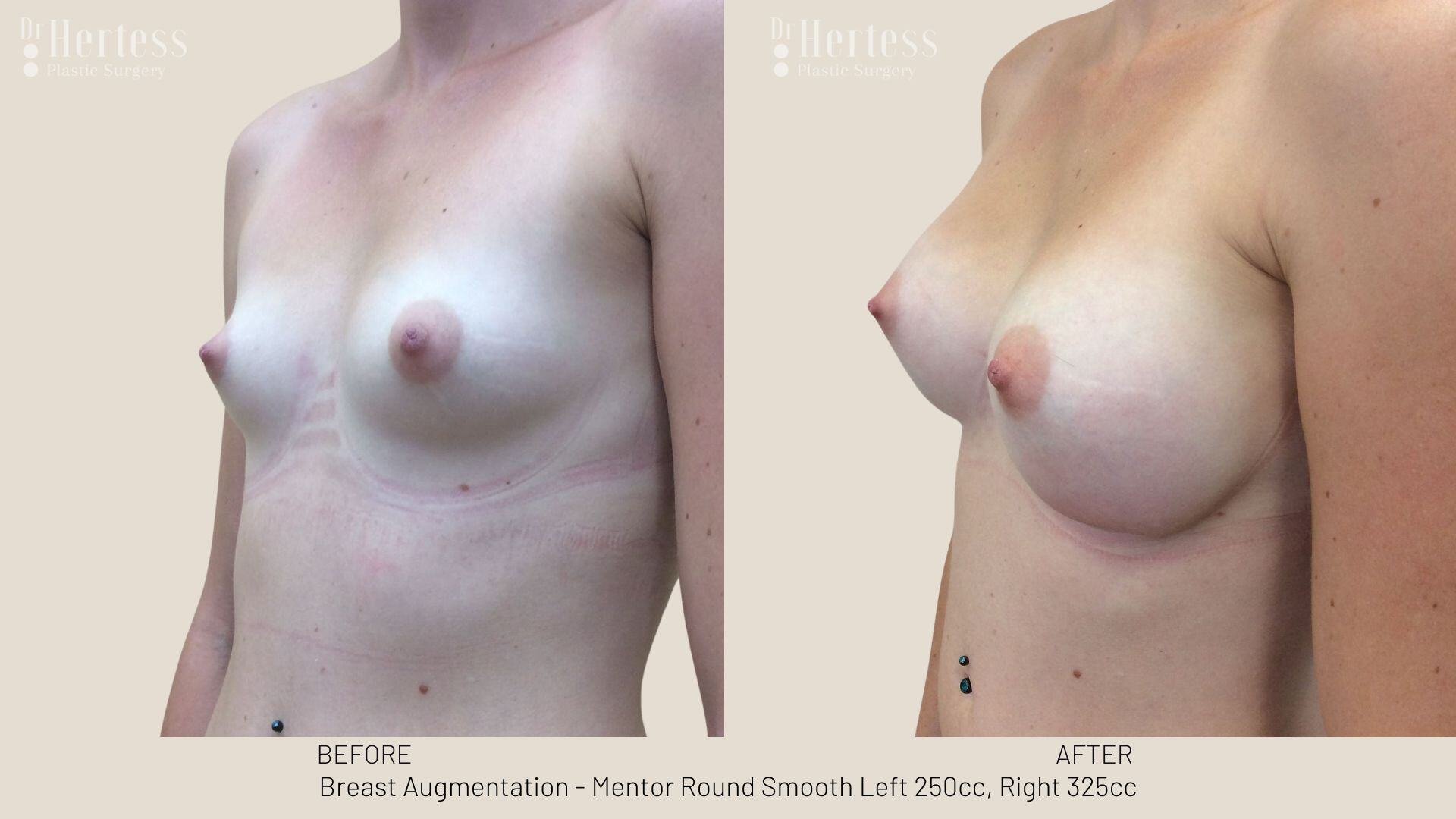 breast aug photos before and after