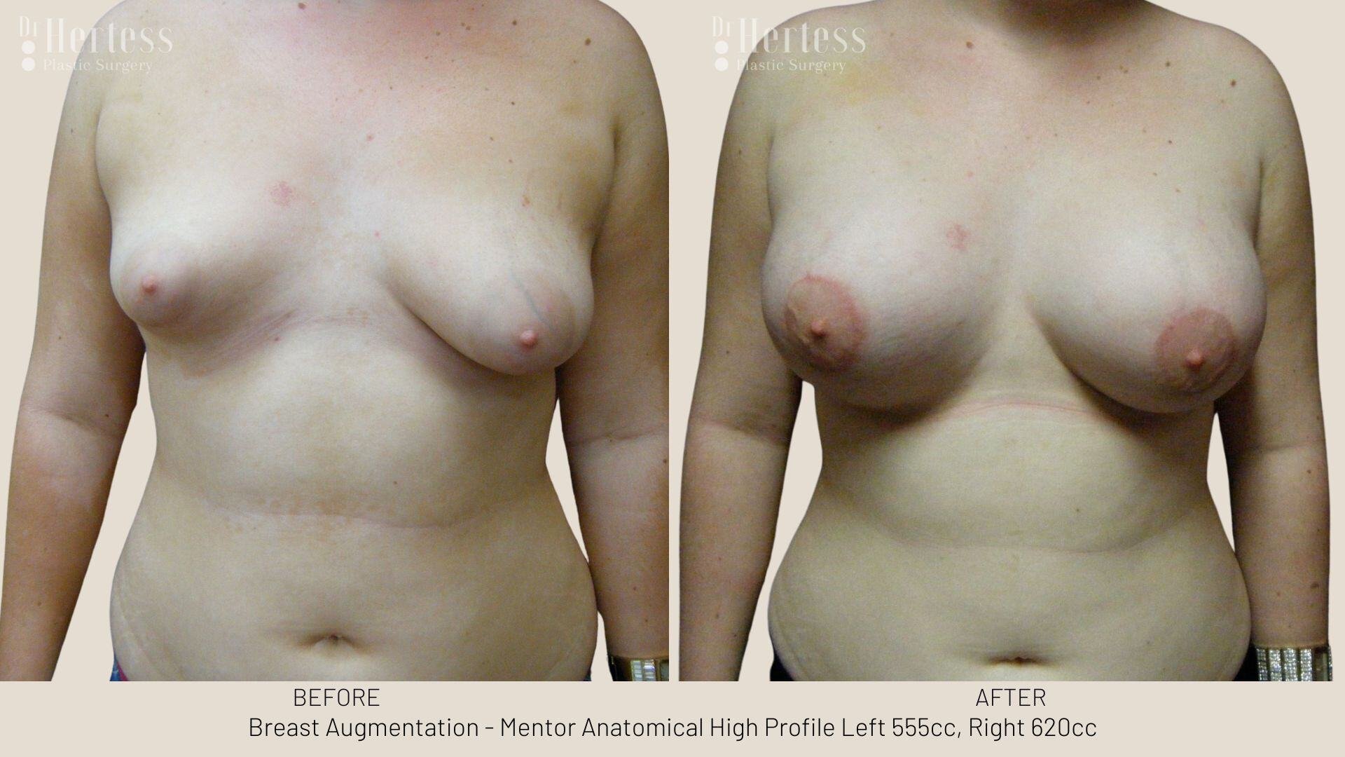breast aug photos before and after