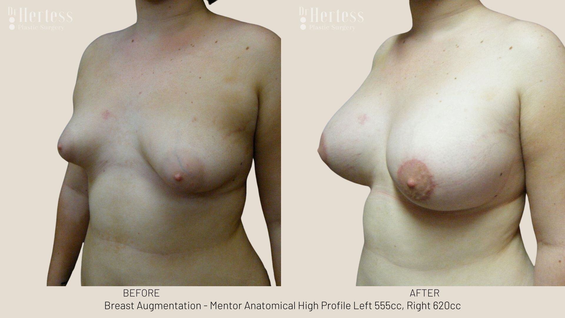 breast aug photos before and after