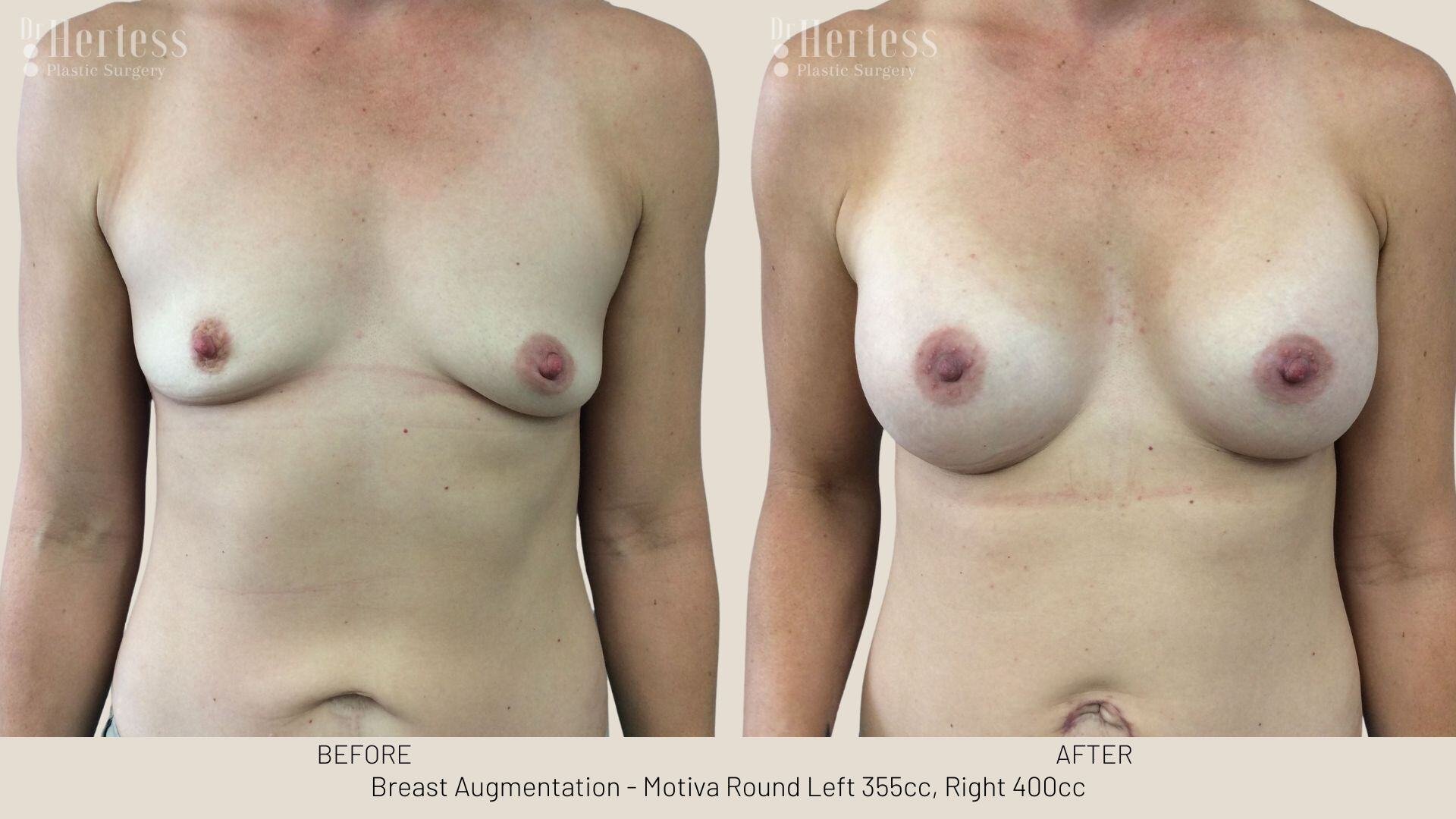 breast aug photos before and after