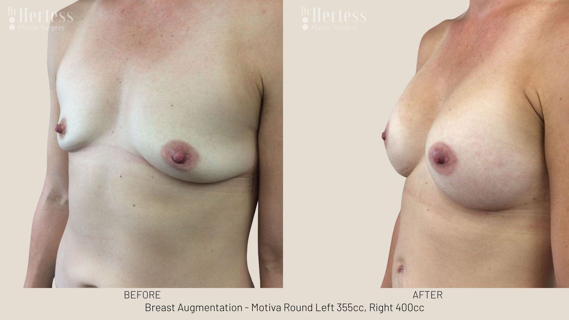 breast aug photos before and after
