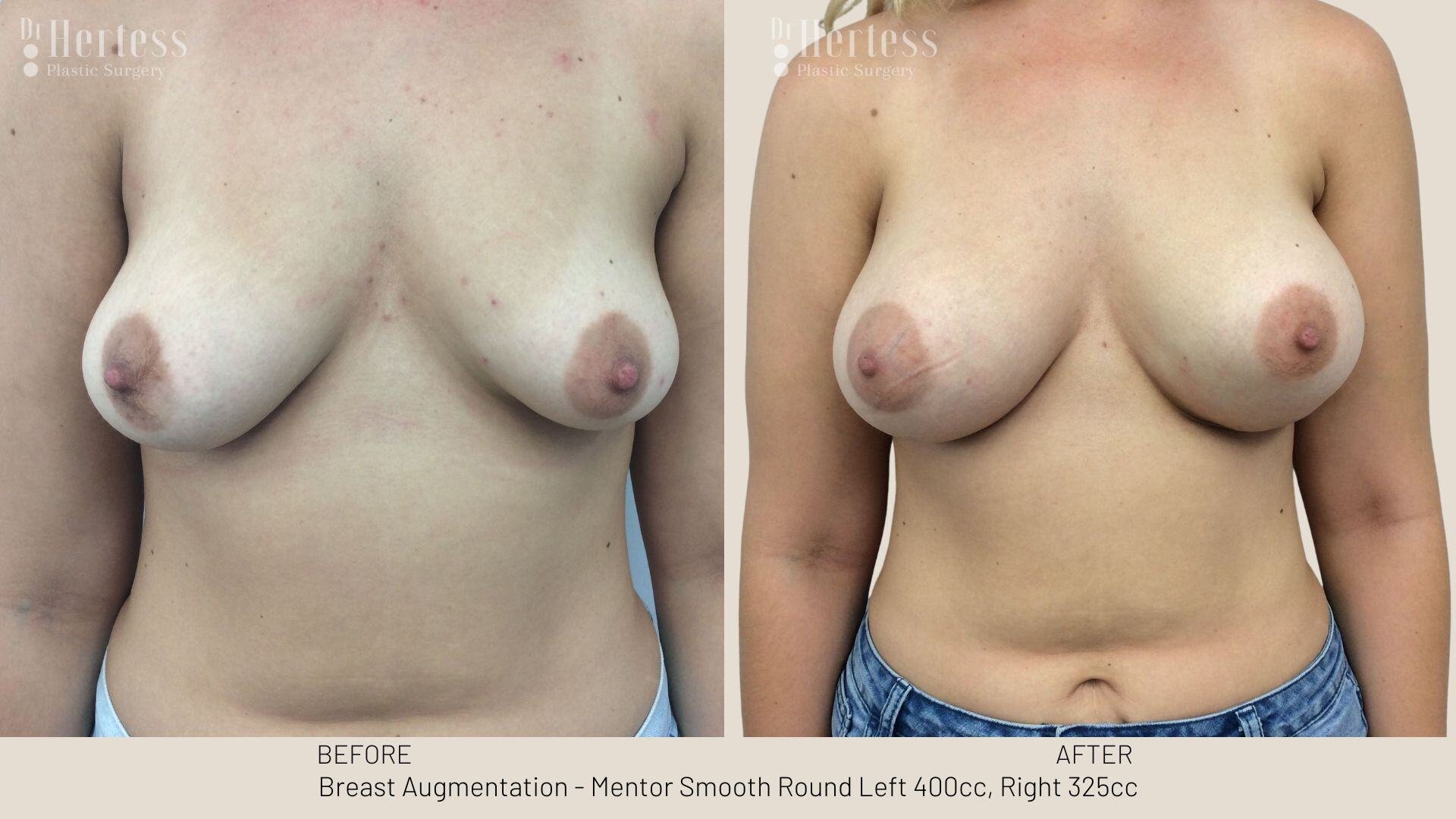 breast aug photos before and after