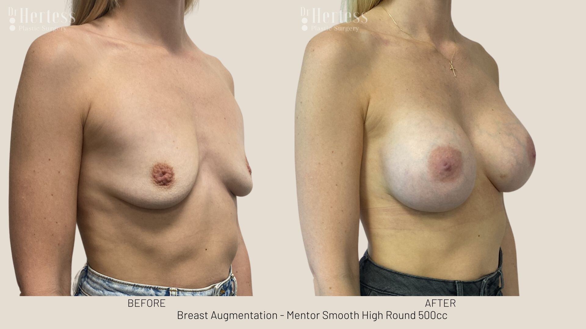 breast implants before and after