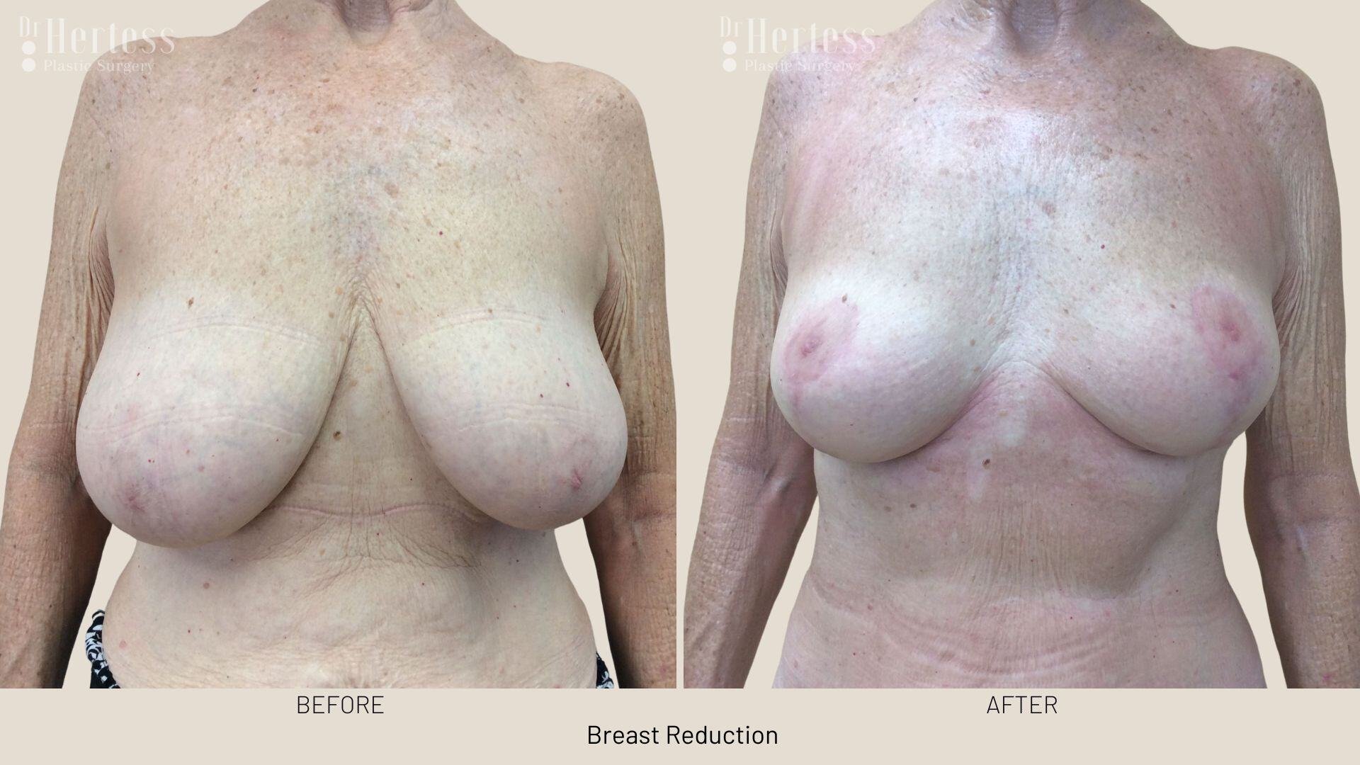 breast reduction before and after