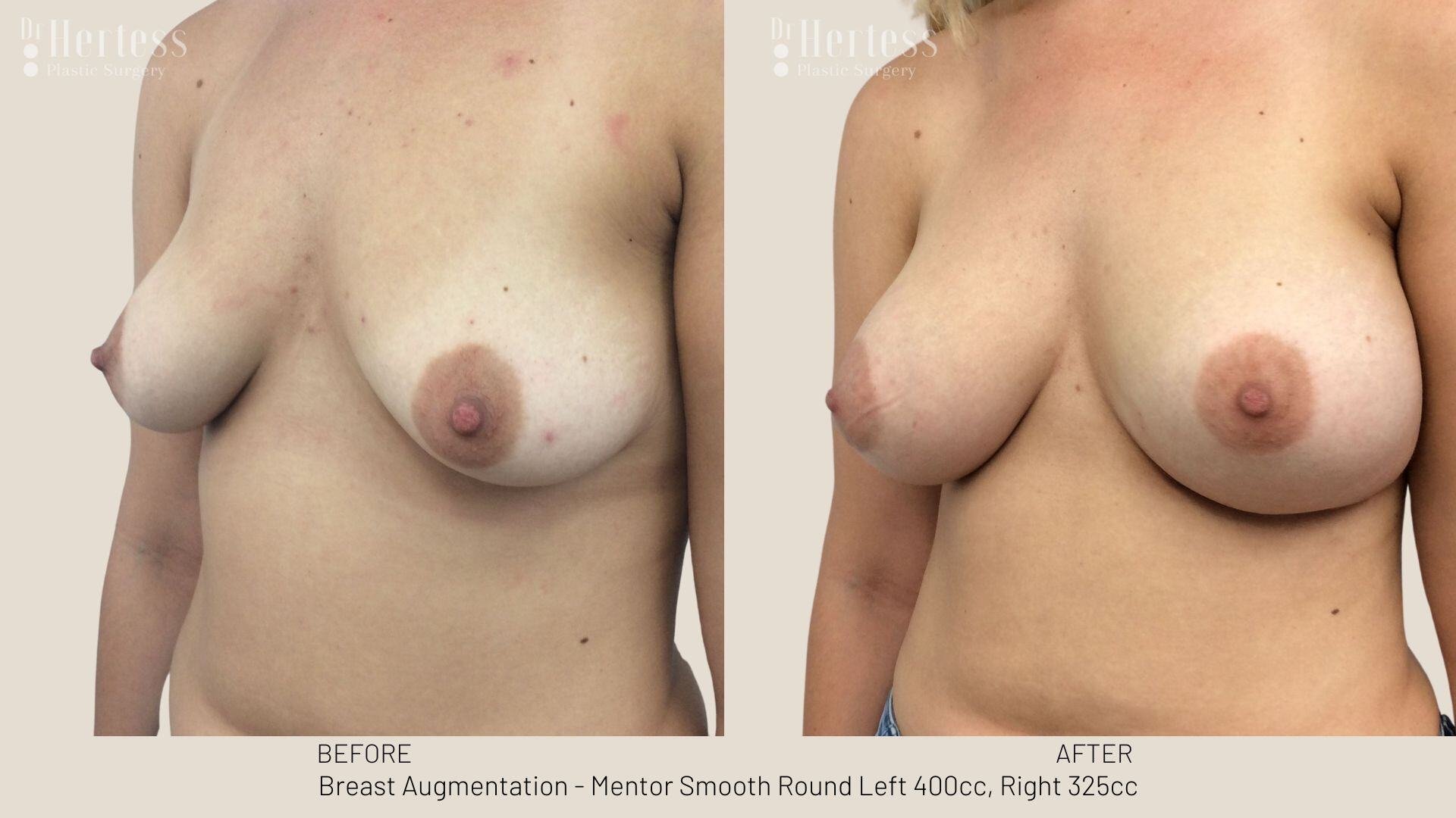 breast aug photos before and after