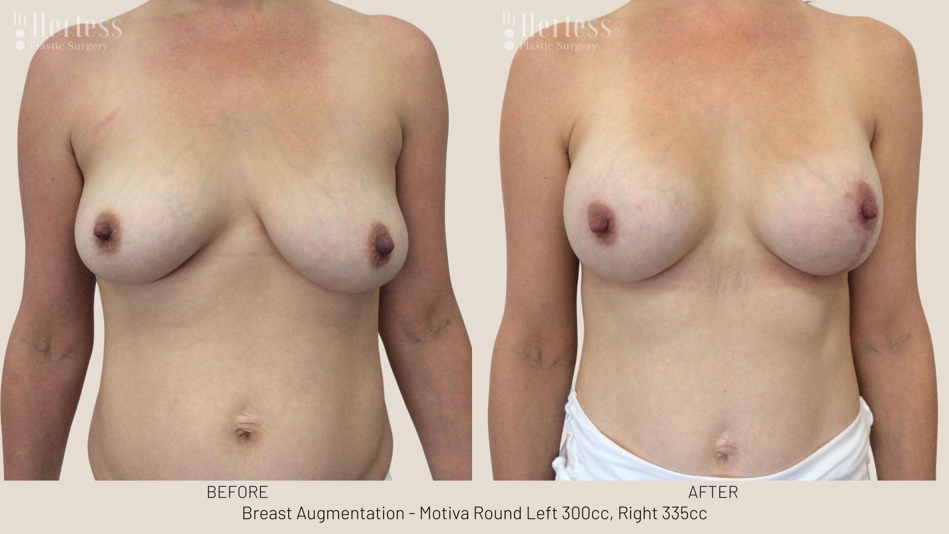 breast aug photos before and after