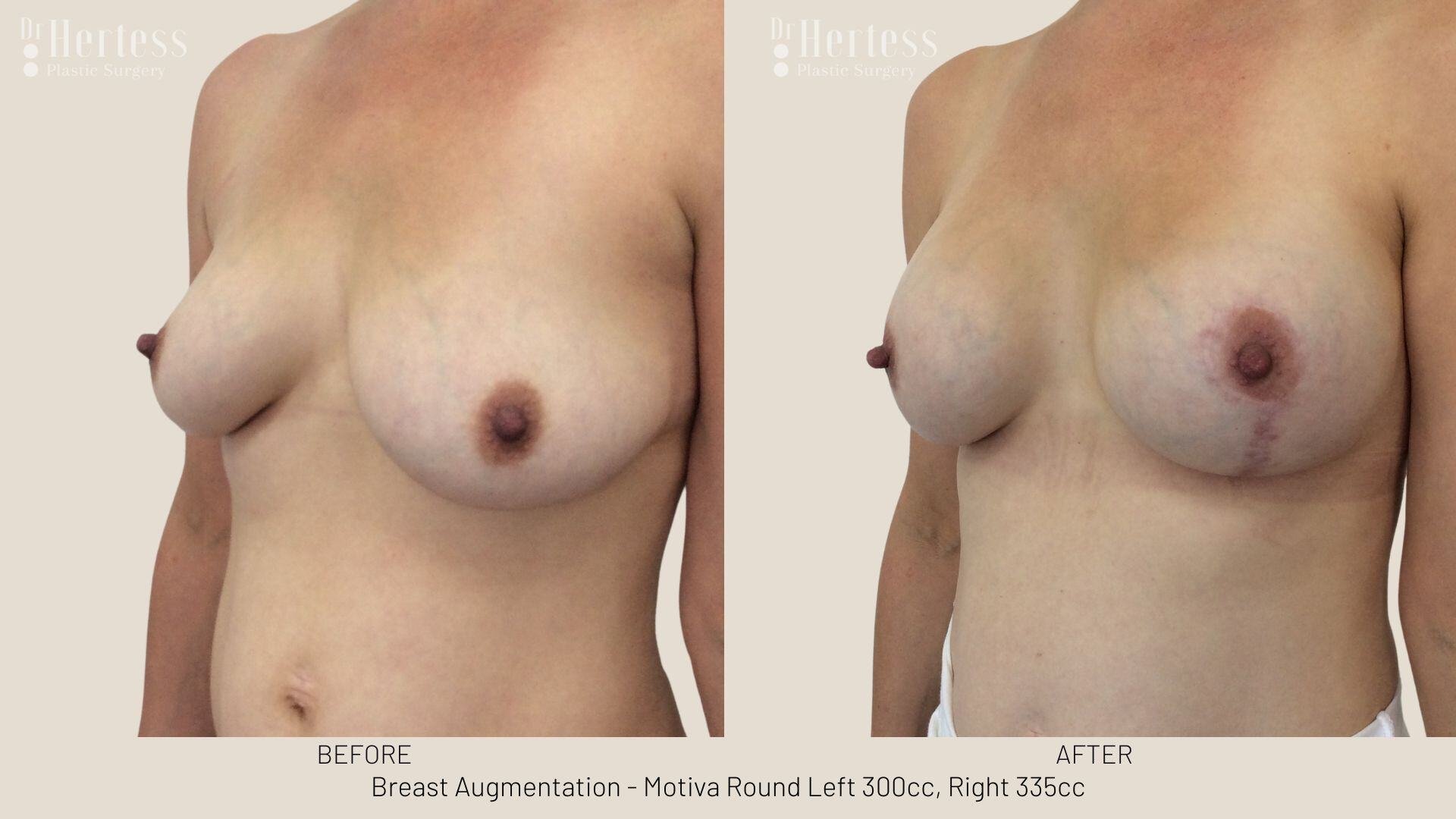 breast aug photos before and after