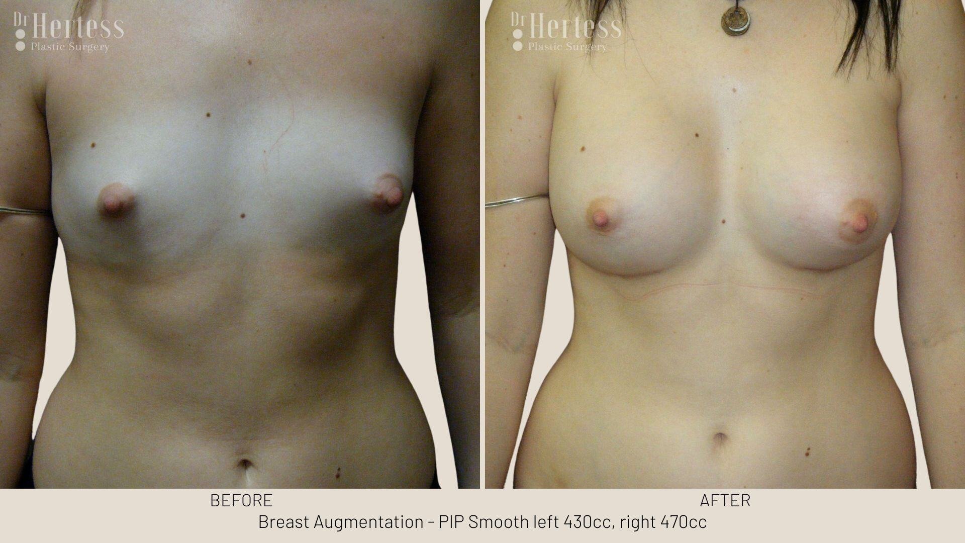breast aug photos before and after