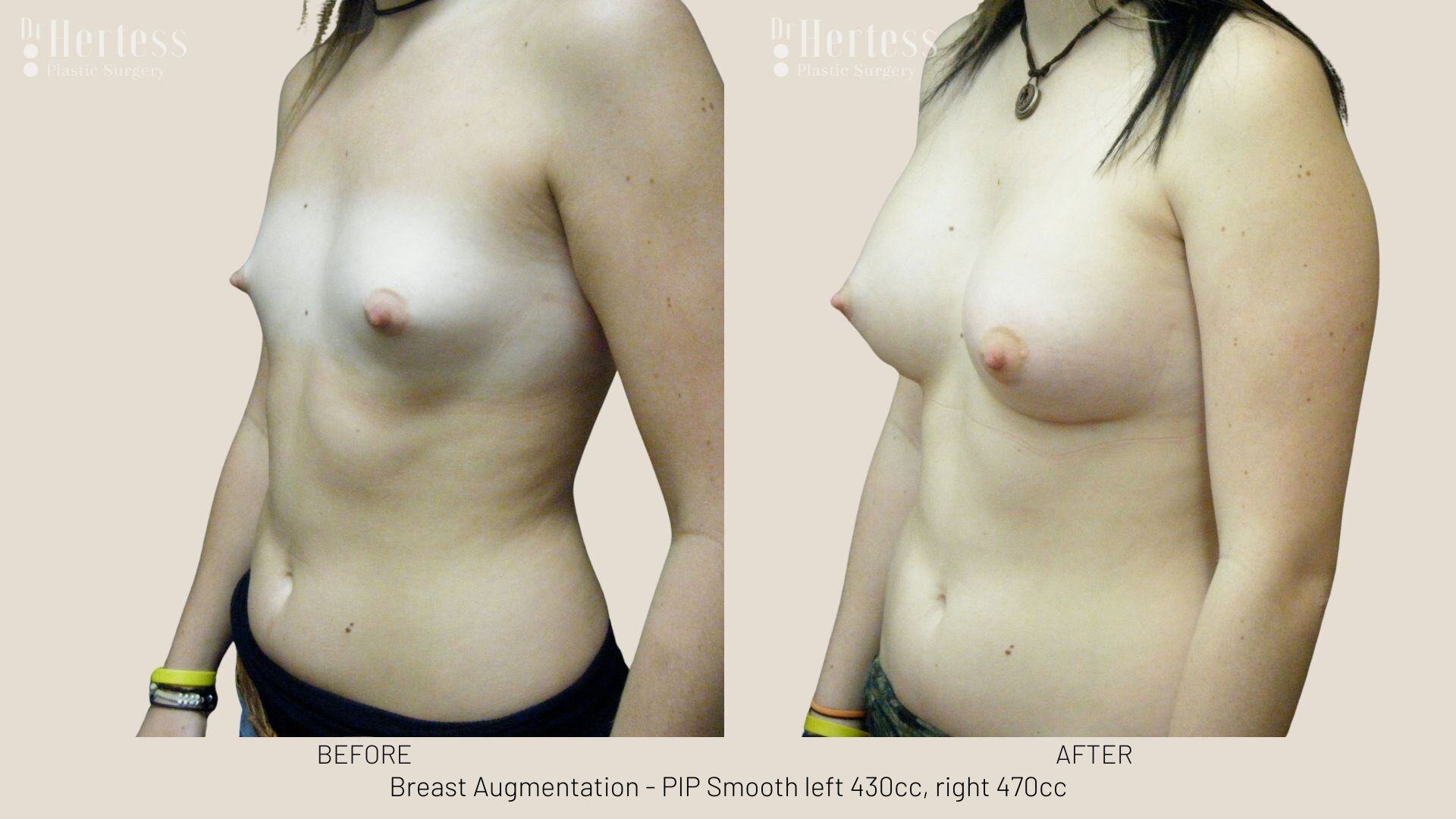 breast aug photos before and after