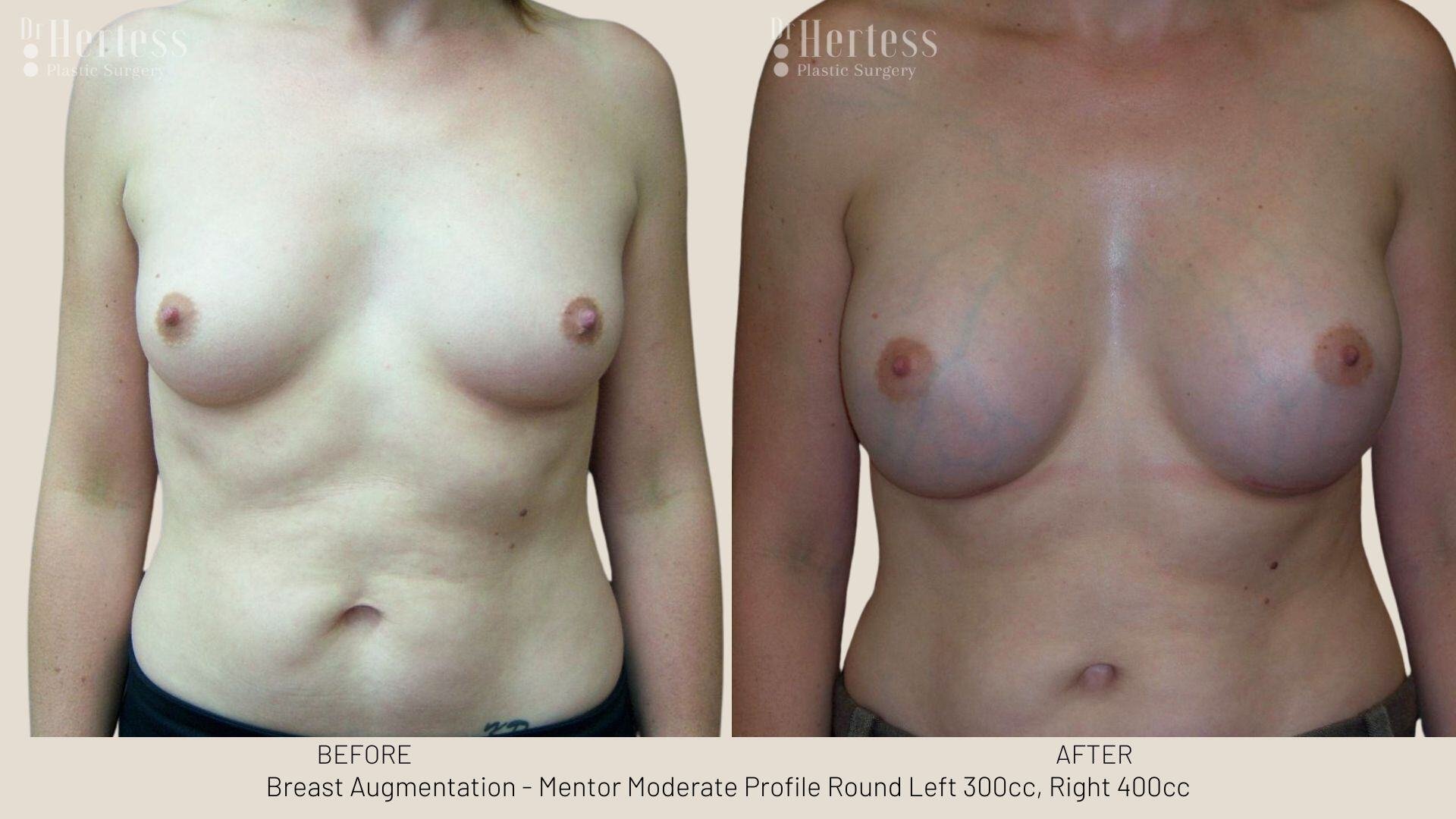 breast aug photos before and after