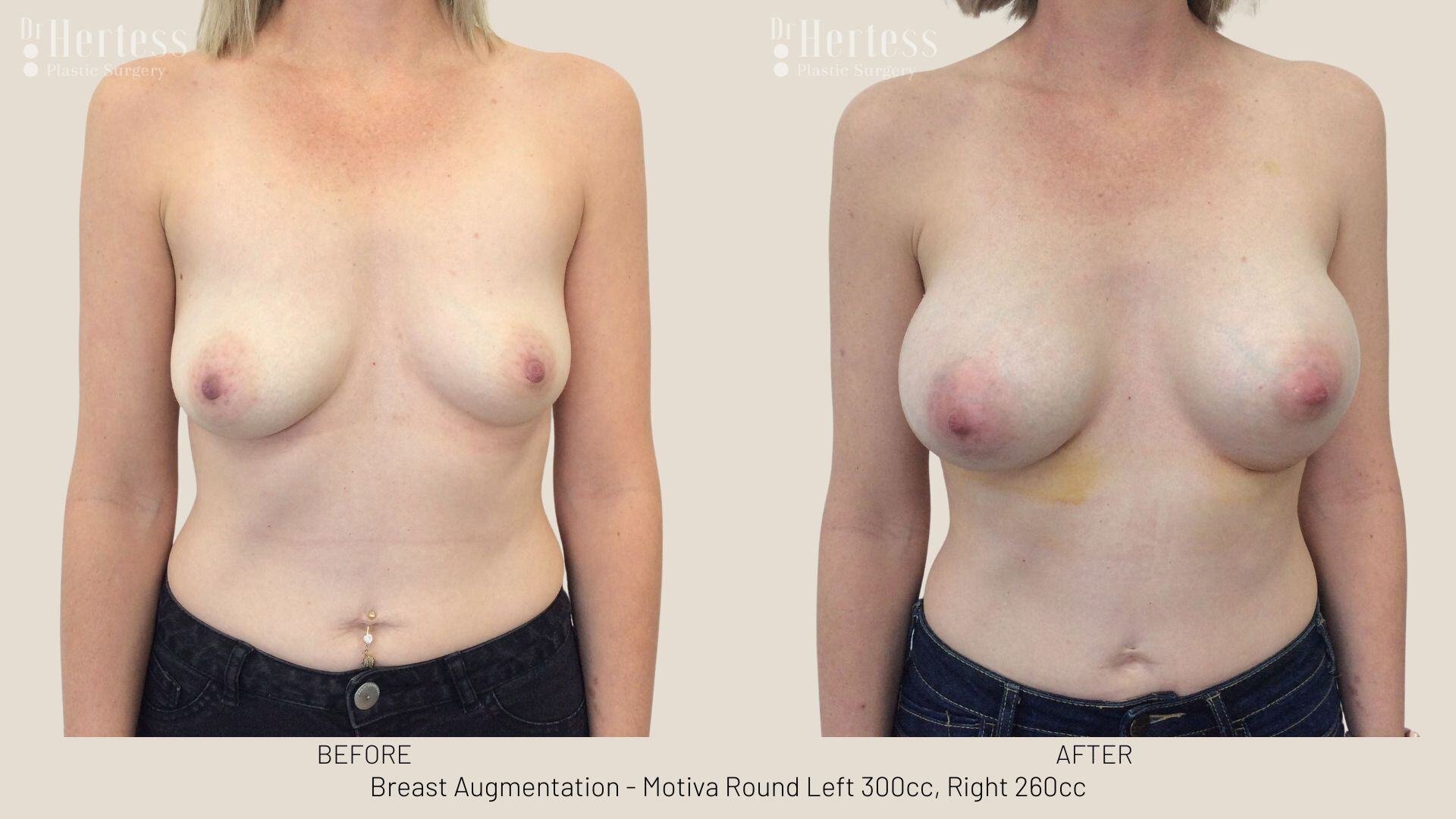 breast aug photos before and after