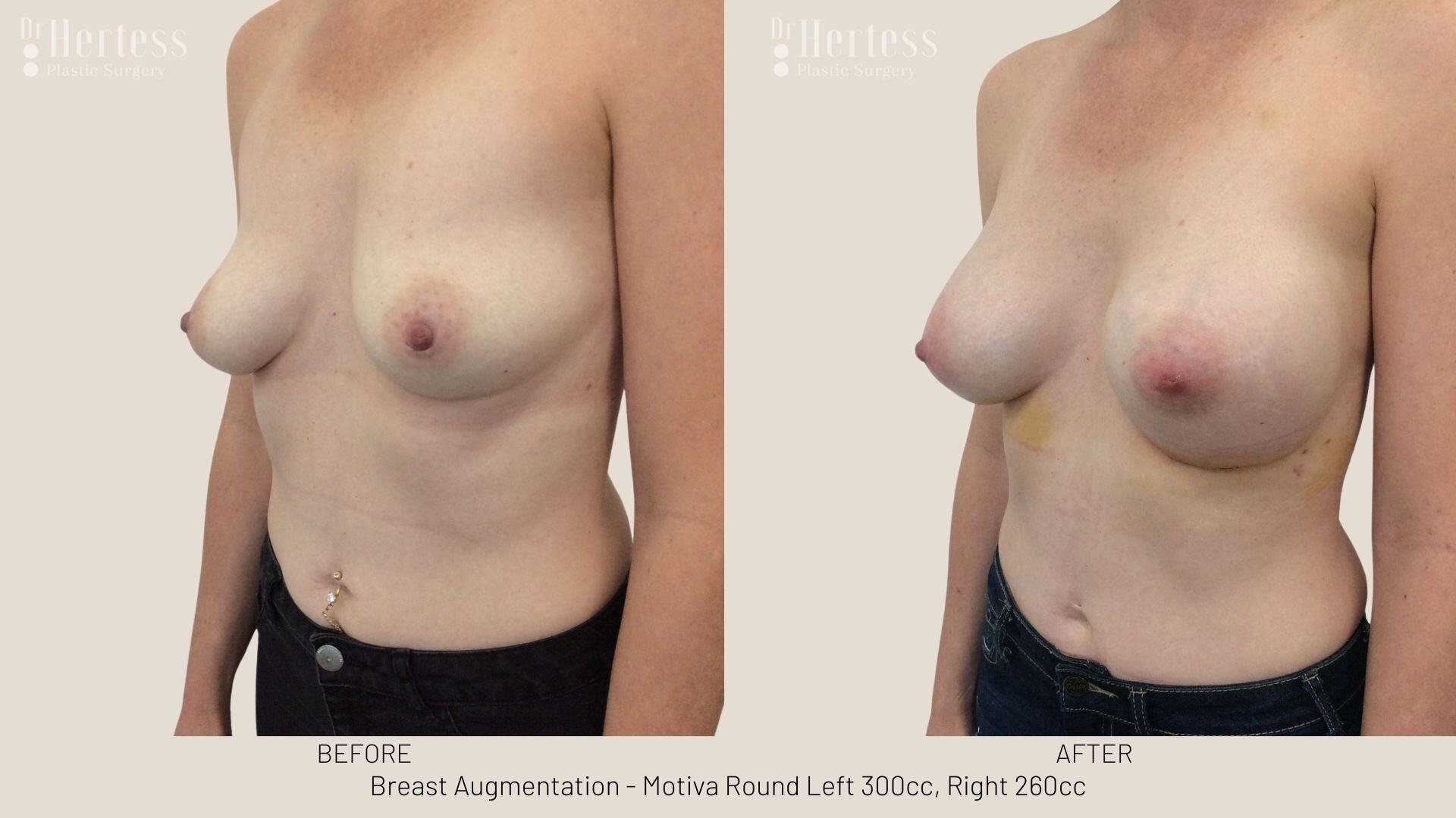 breast aug photos before and after