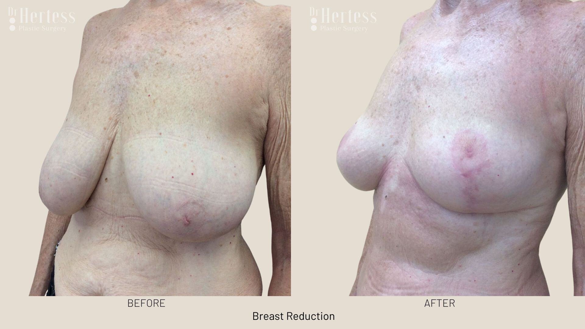 breast reduction before and after