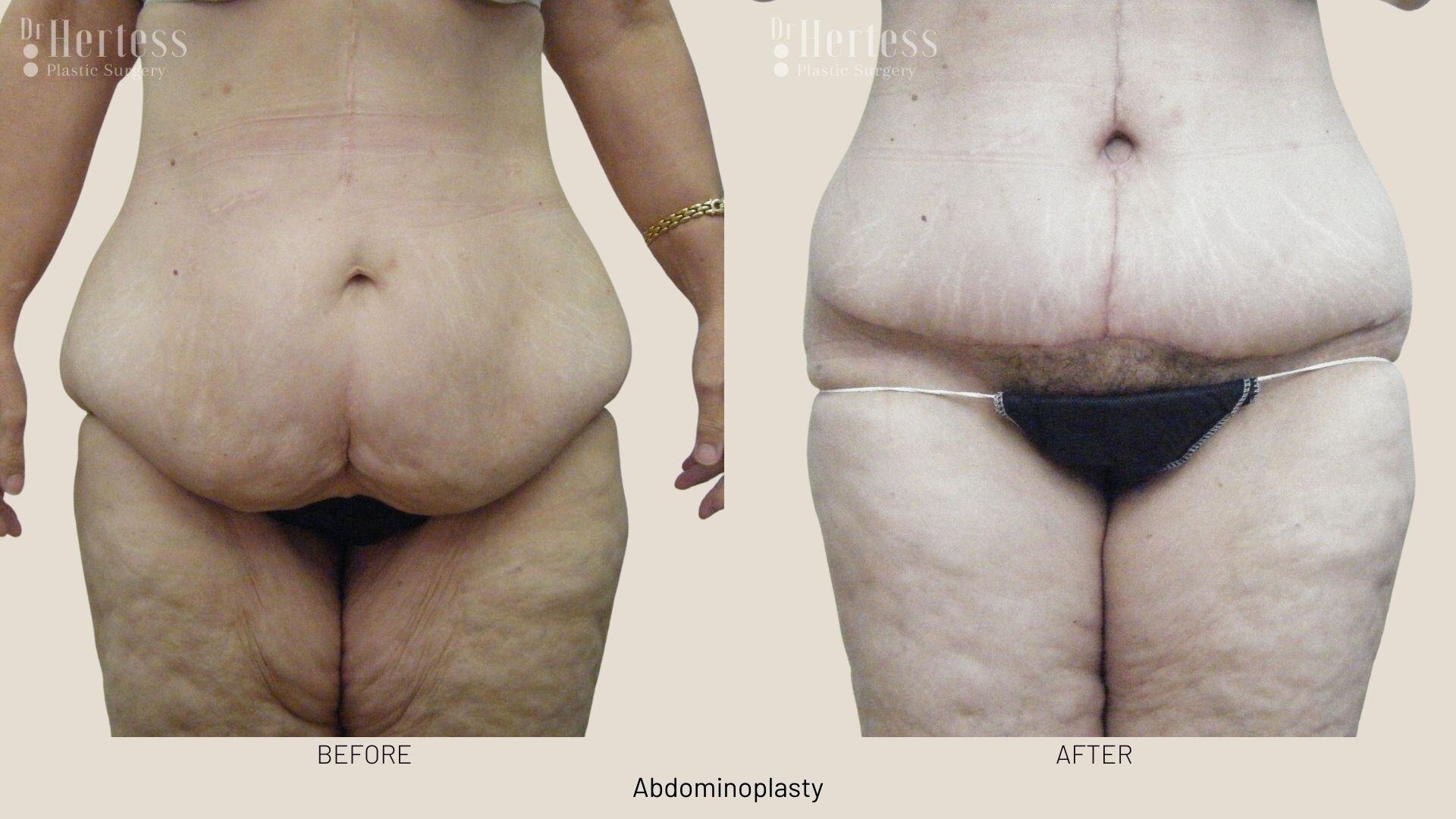 abdominoplasty before and after photos