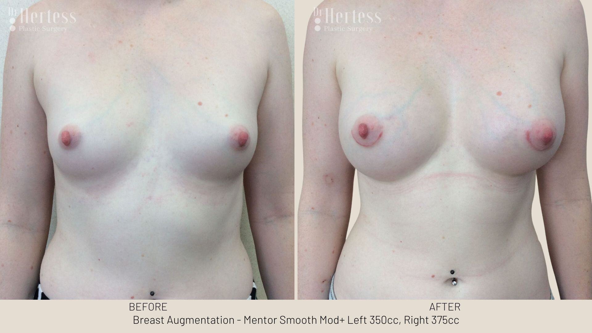 breast aug photos before and after