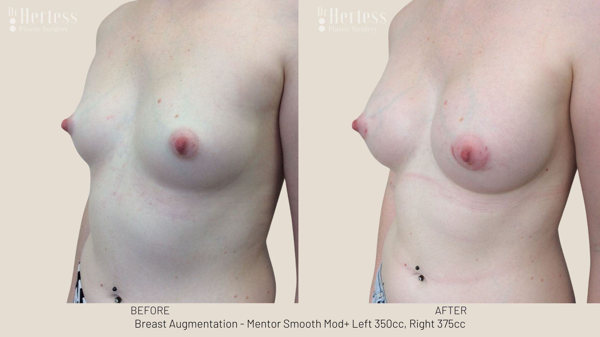 breast aug photos before and after