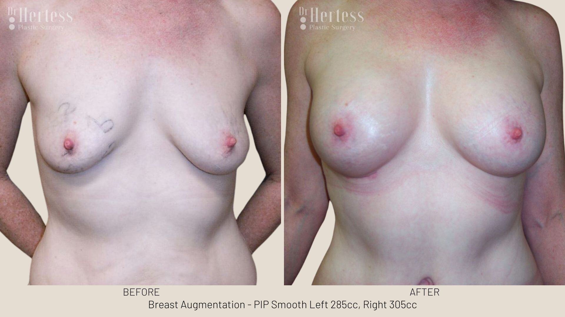 breast aug photos before and after
