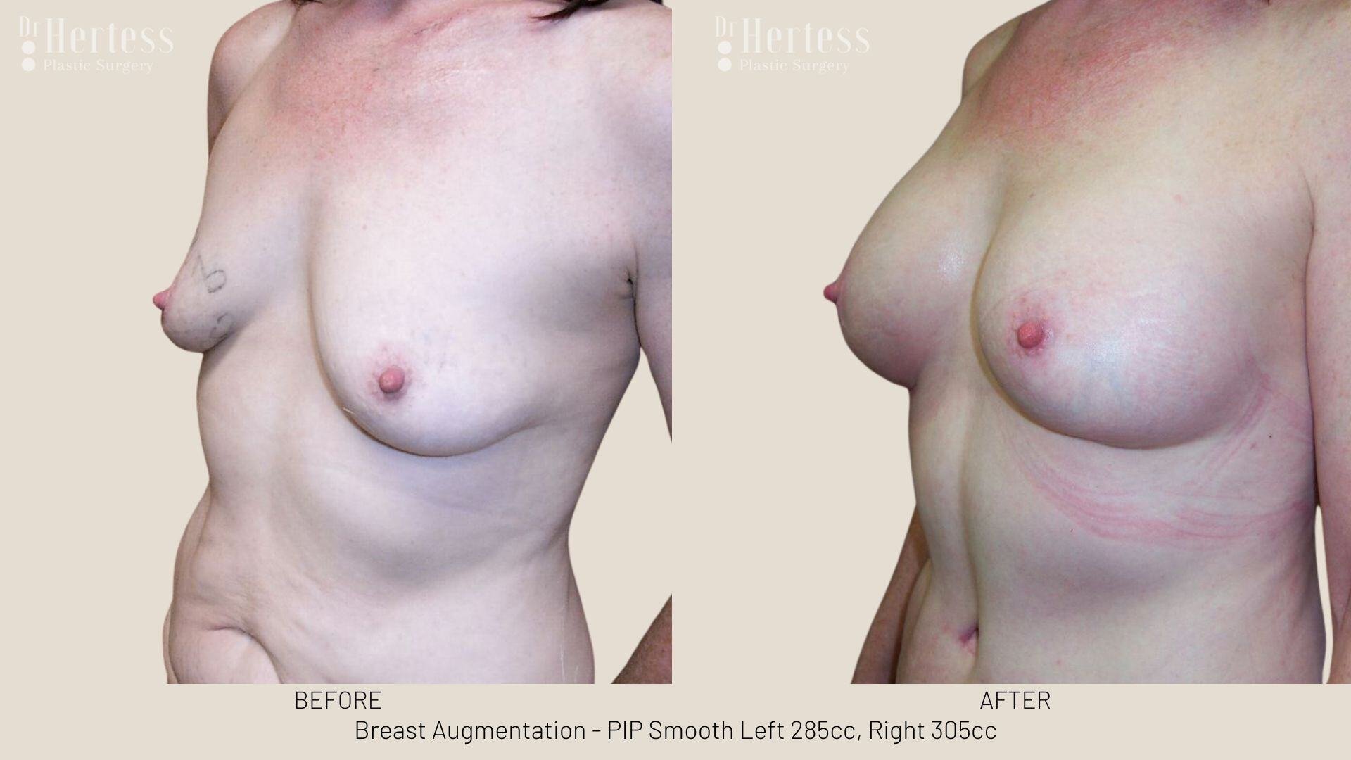 breast aug photos before and after