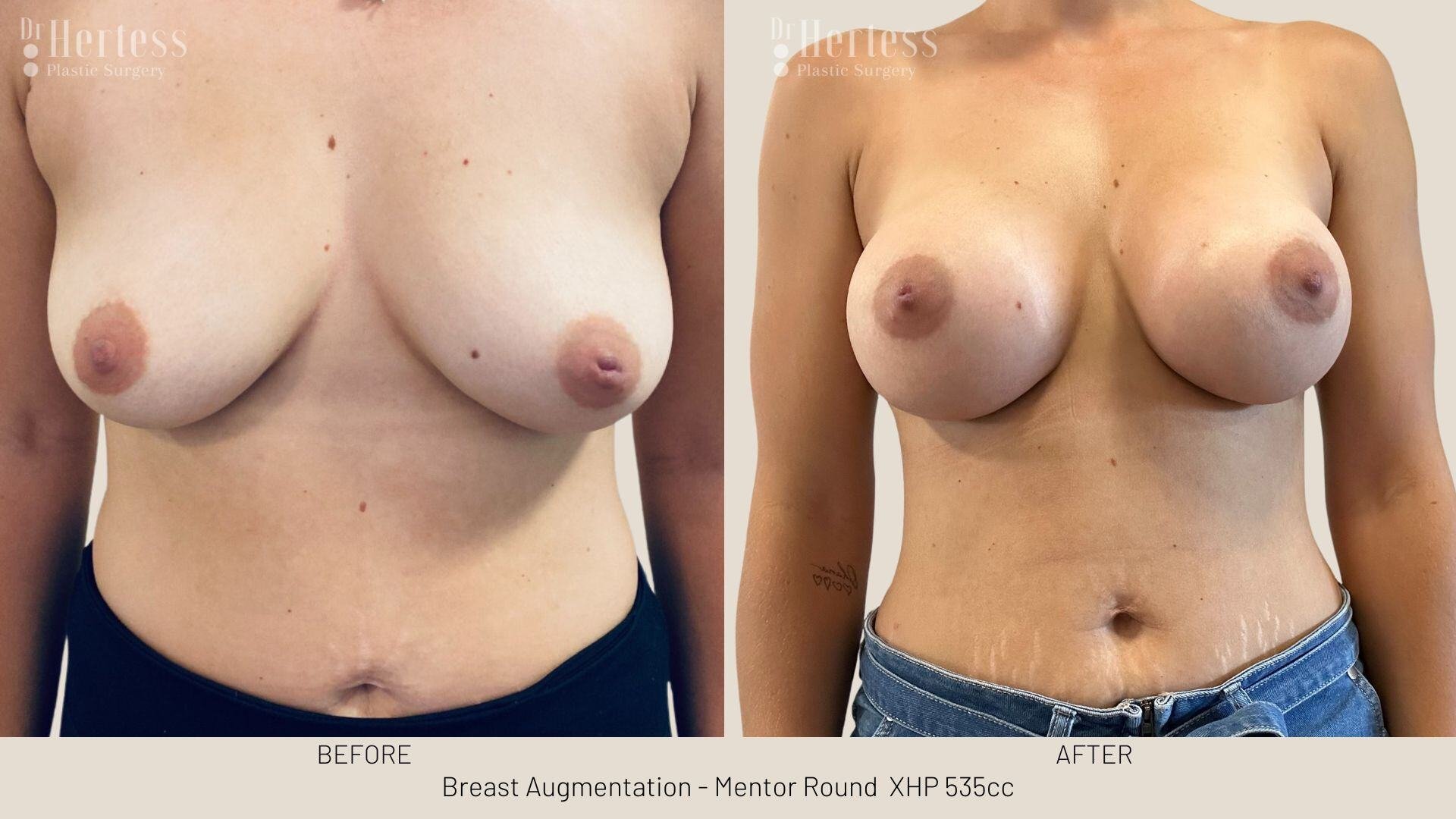 breast aug photos before and after