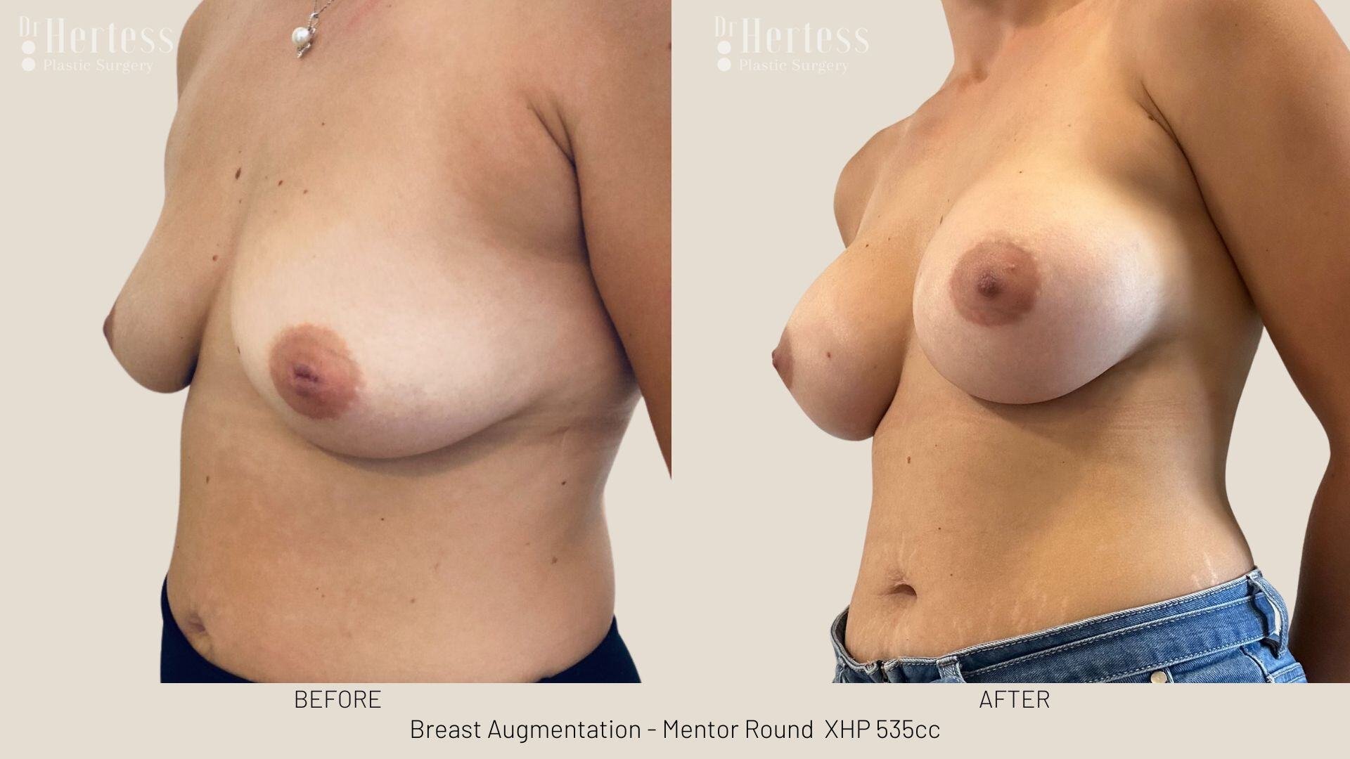 breast aug photos before and after