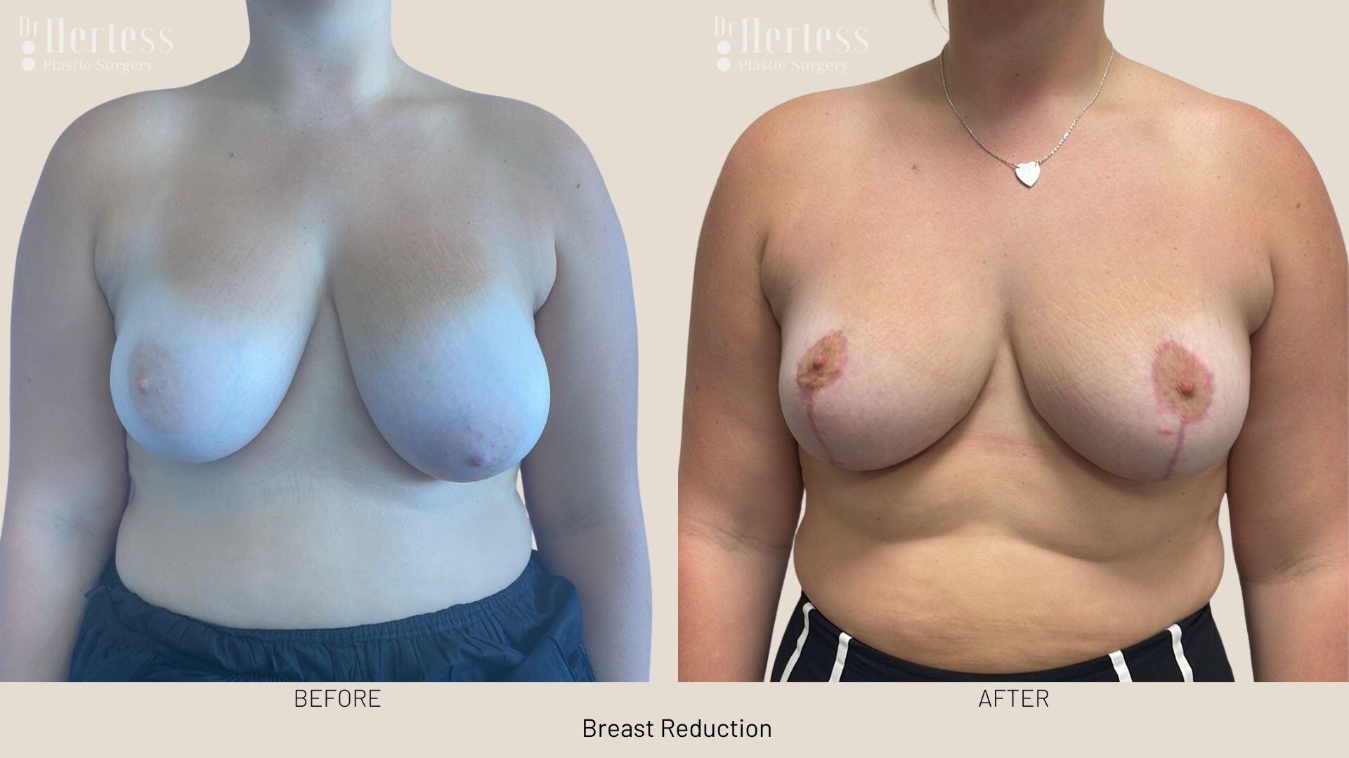 breast reduction before and after