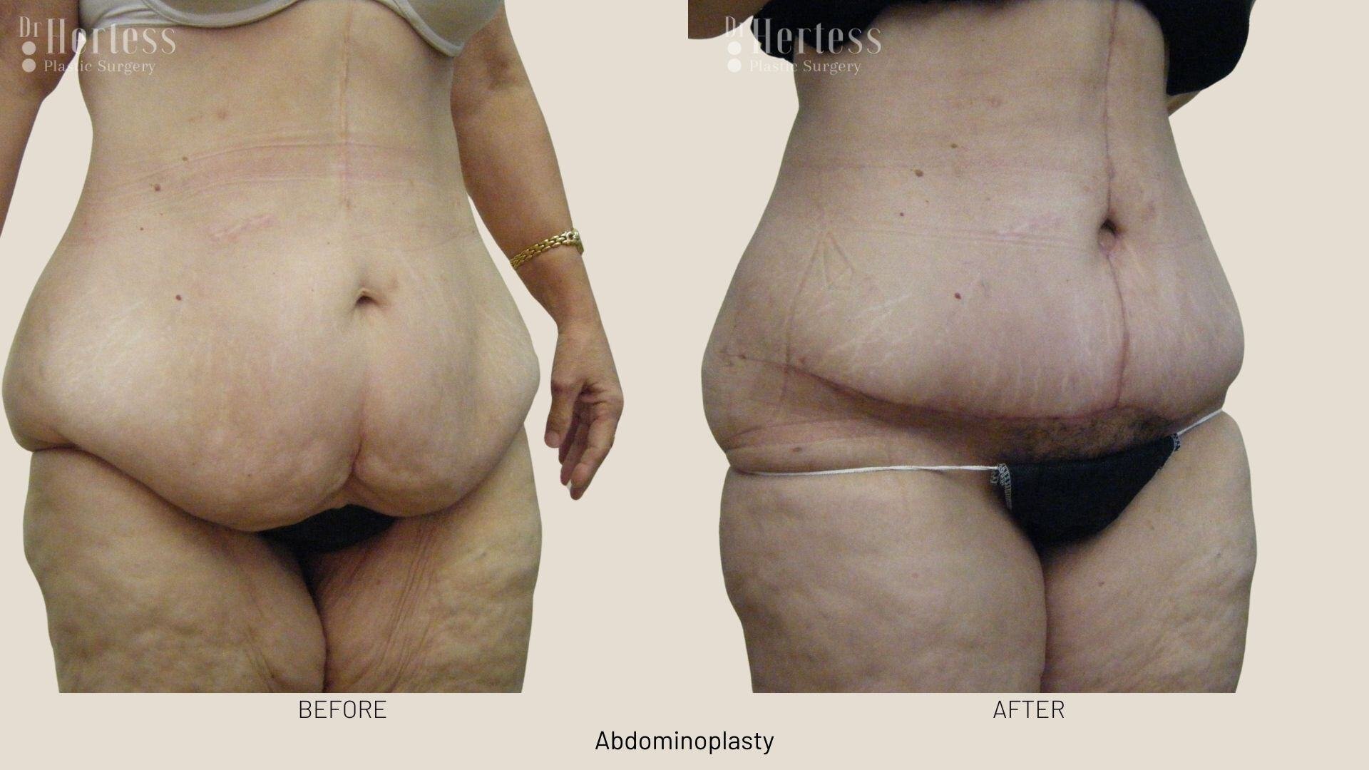 abdominoplasty before and after photos
