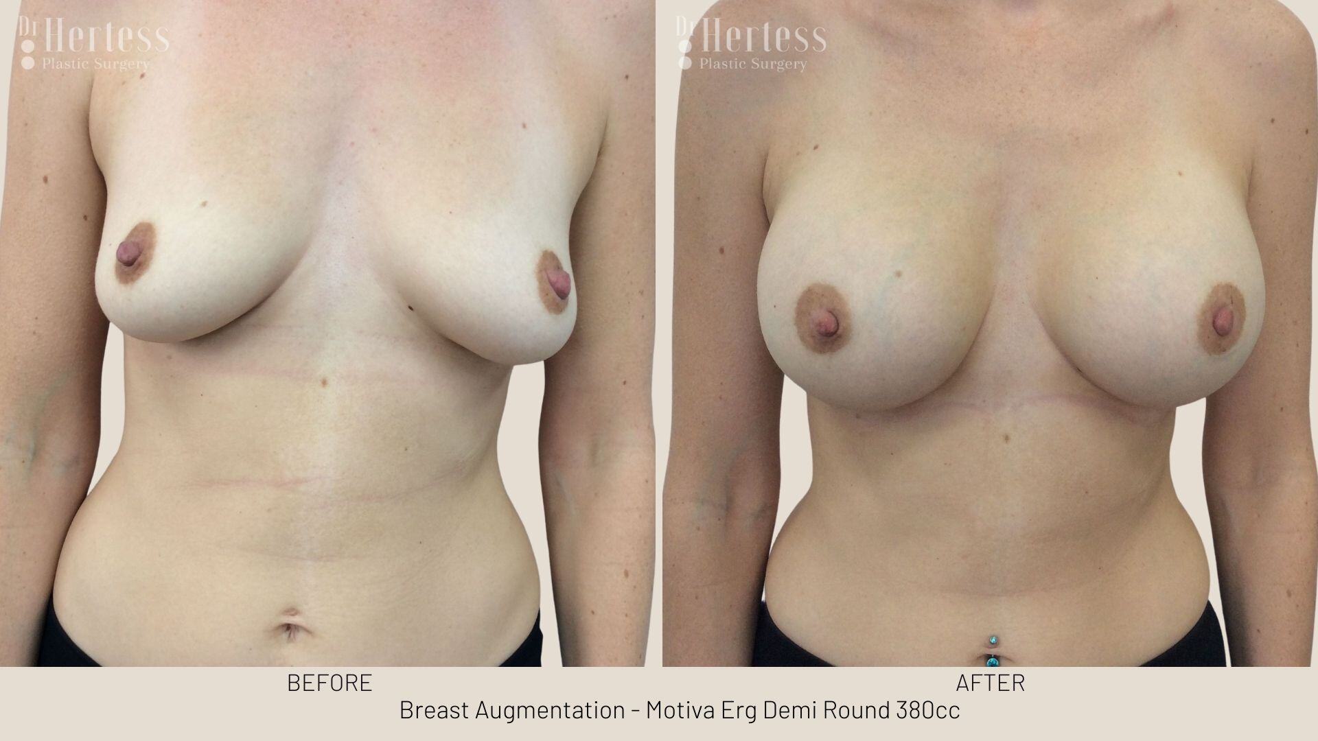 breast implants before and after