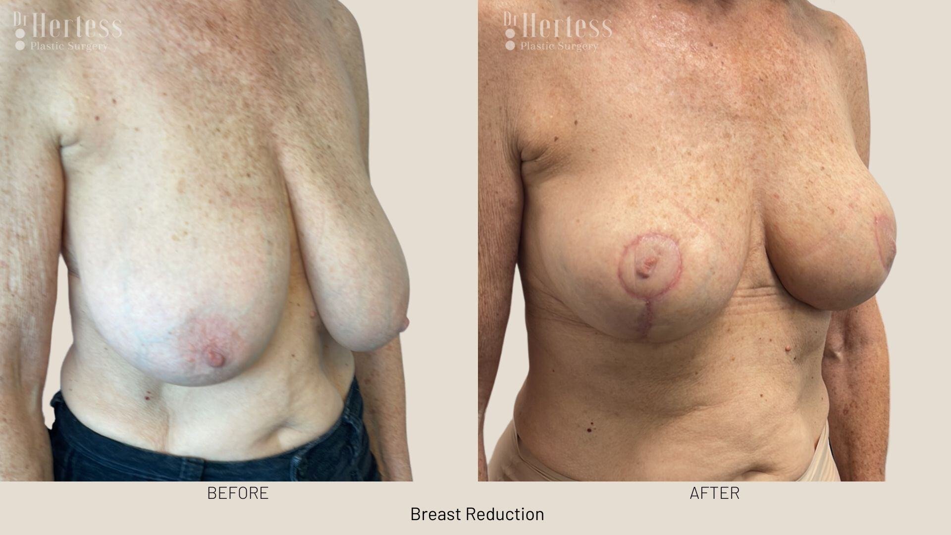 breast reduction before and after