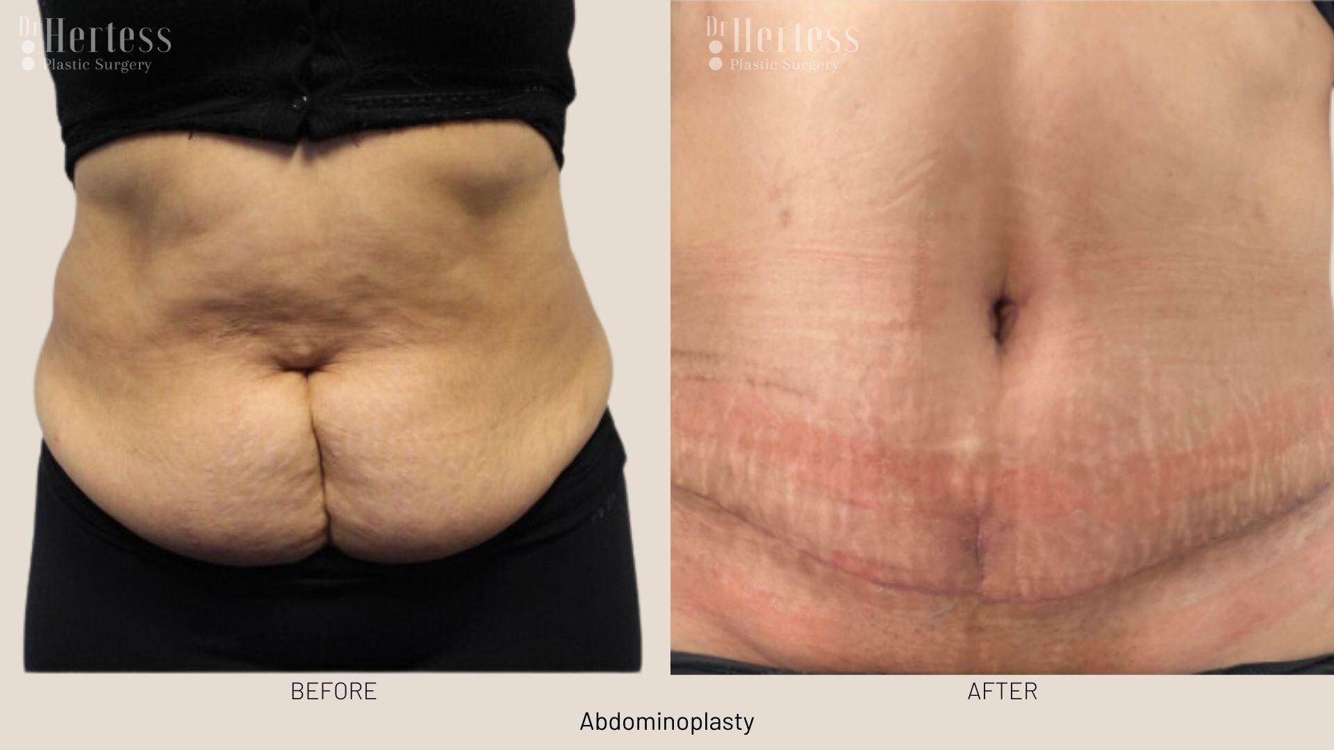 abdominoplasty before and after photos
