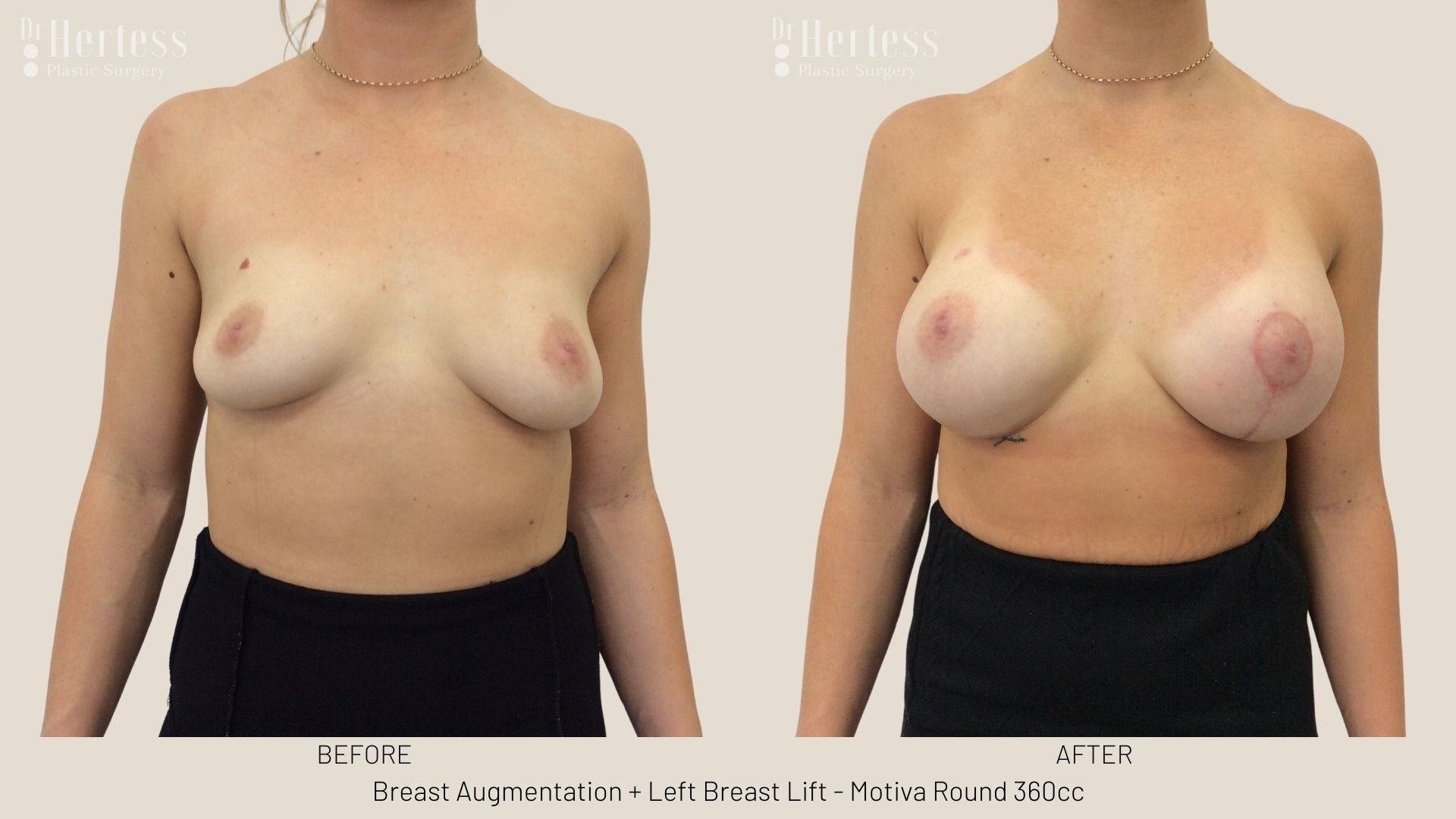 breast aug and lift photos before and after
