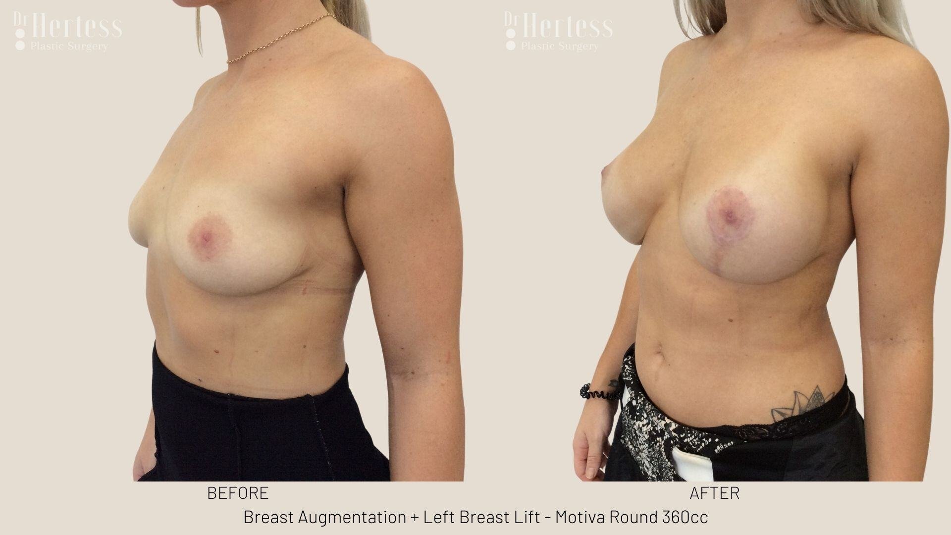 breast aug and lift photos before and after