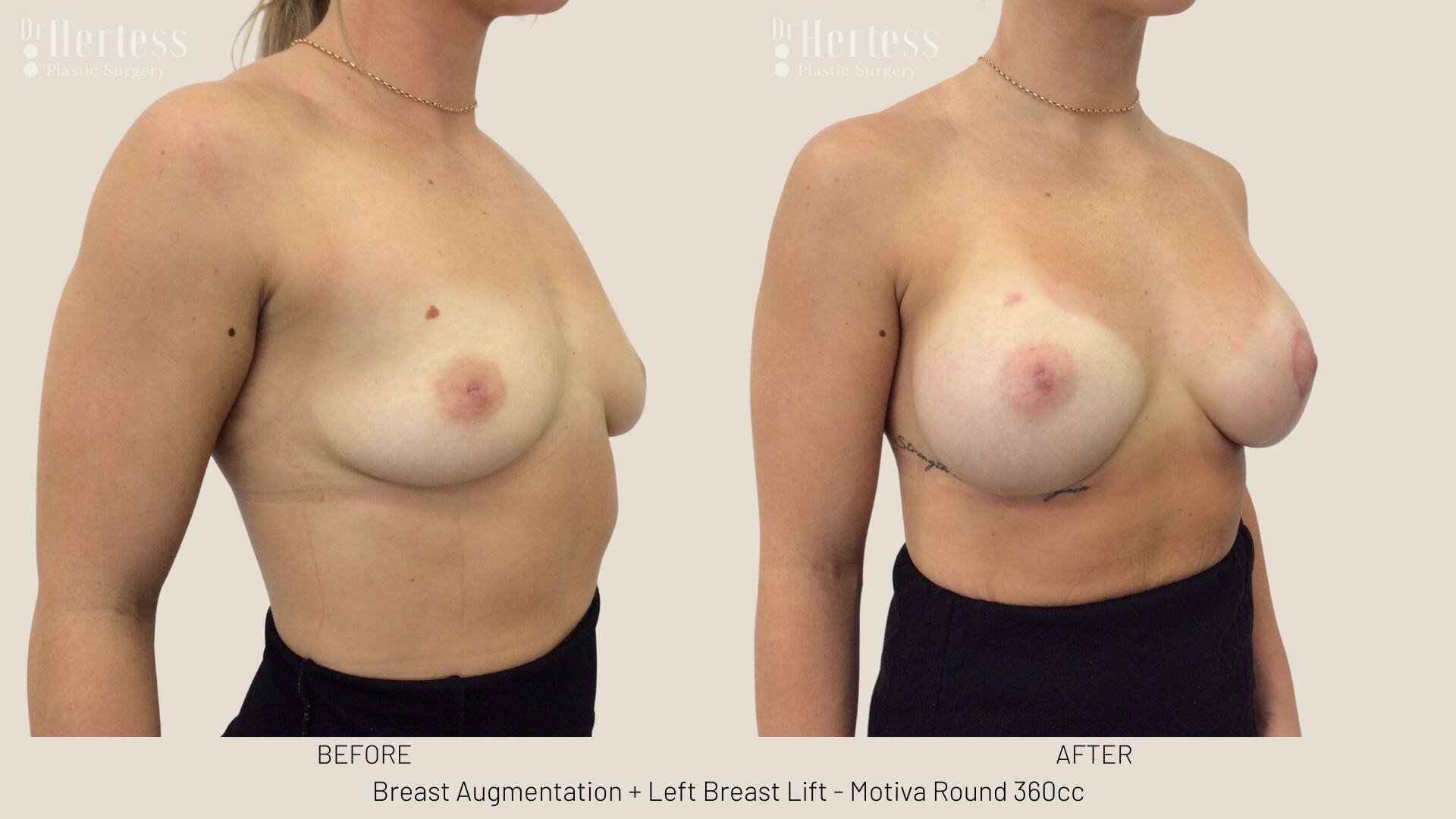 breast aug and lift photos before and after