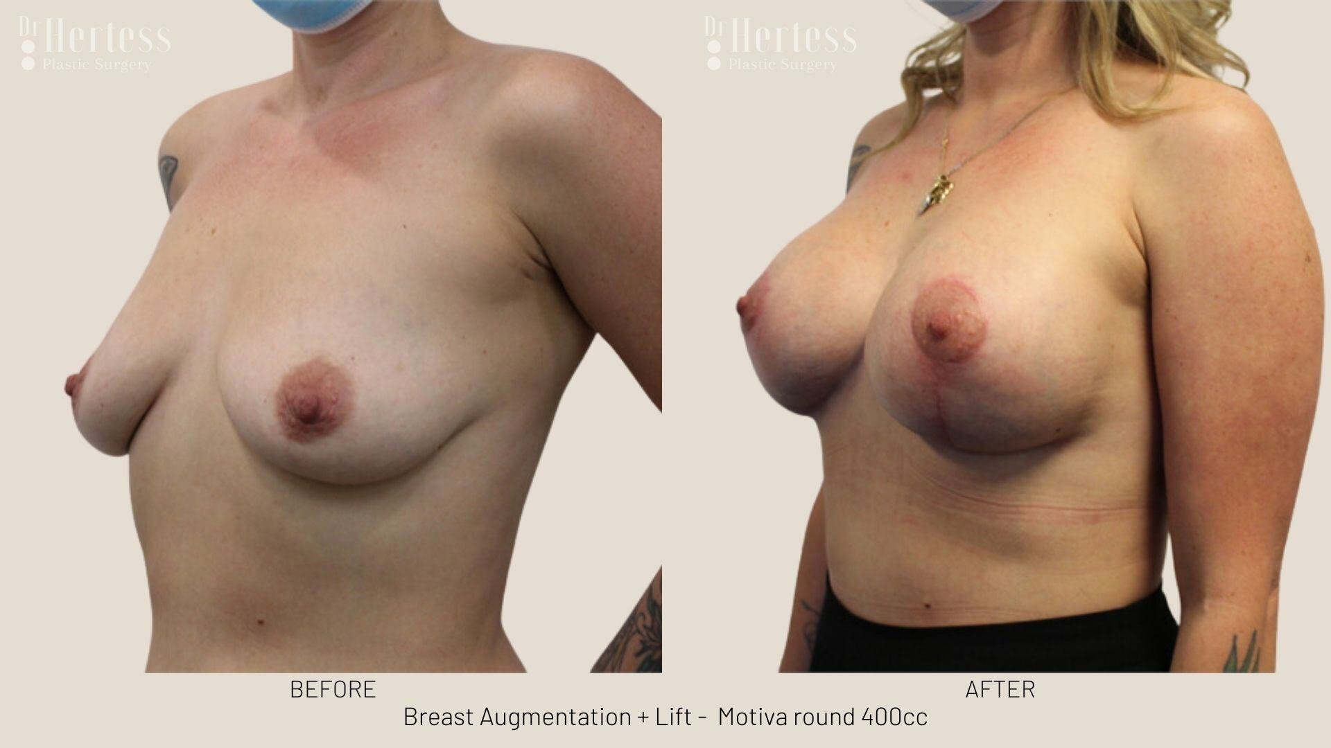 breast aug and lift photos before and after