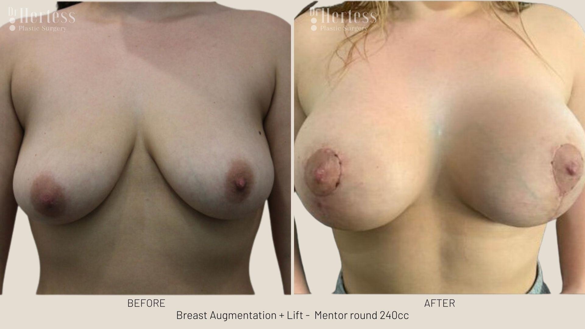 breast aug and lift photos before and after