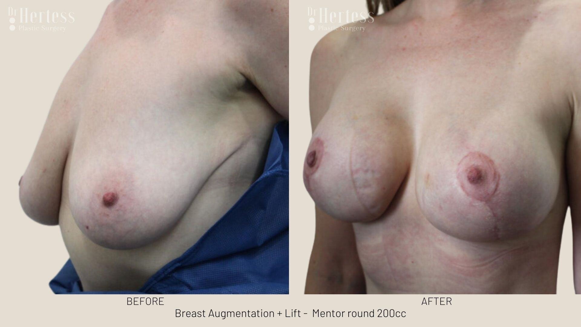 breast aug and lift photos before and after