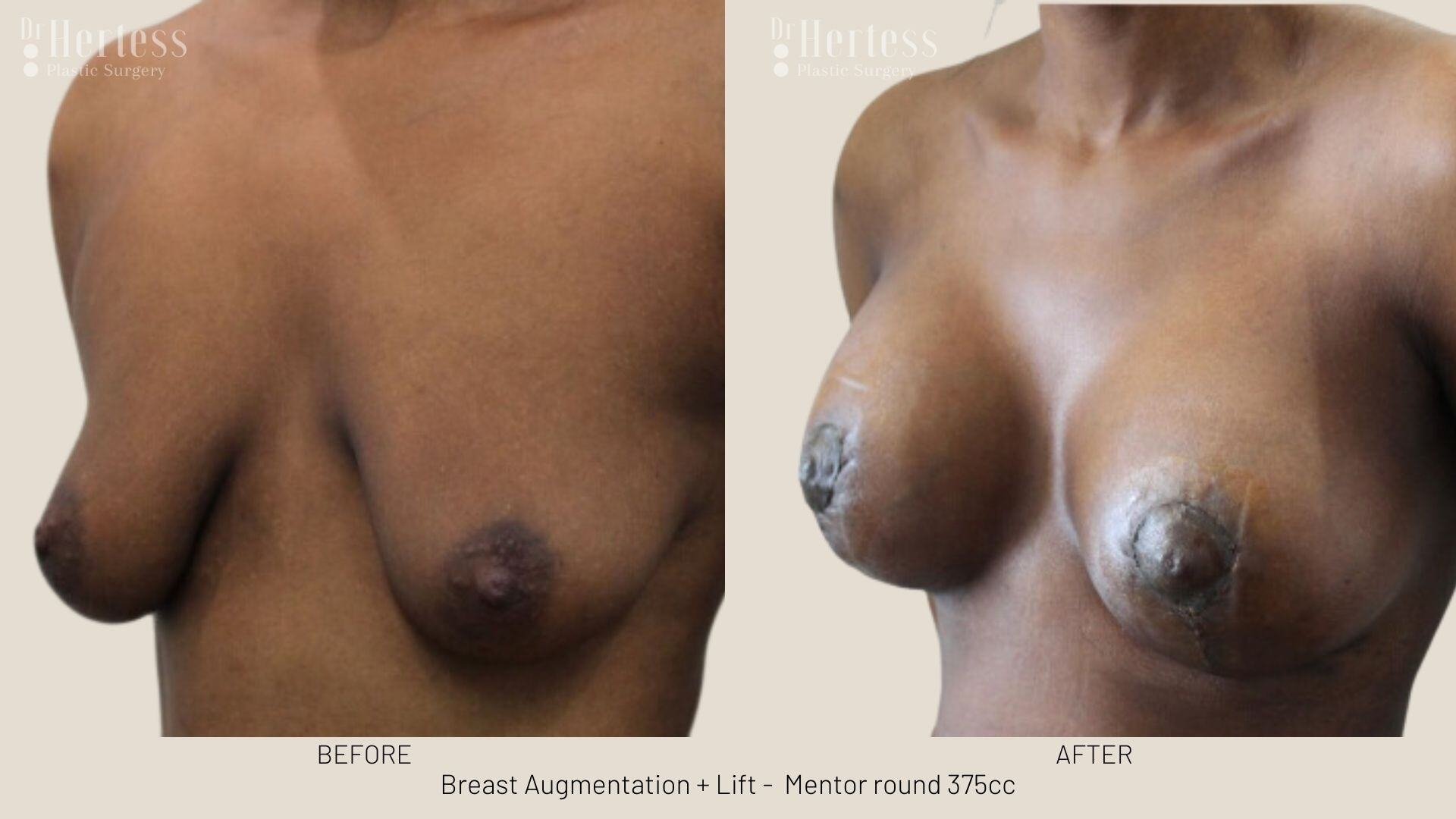 breast aug and lift photos before and after