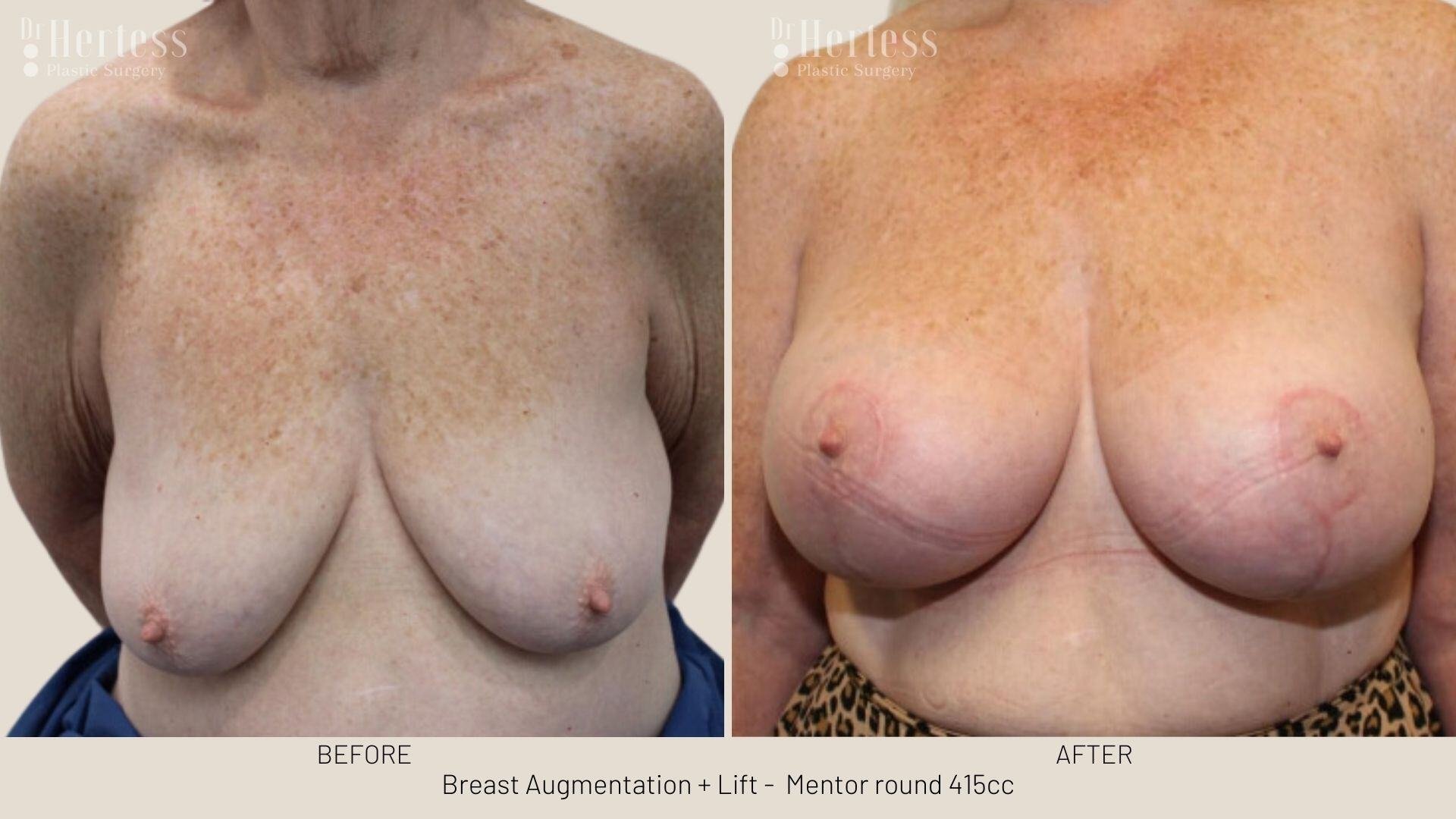 breast aug and lift photos before and after