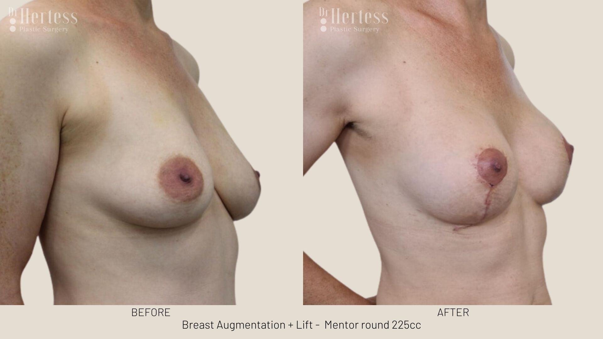 breast aug and lift photos before and after