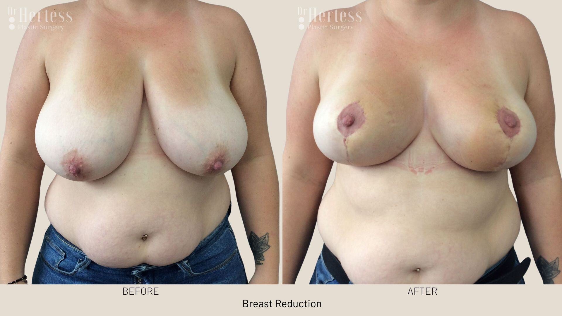 breast reduction before and after