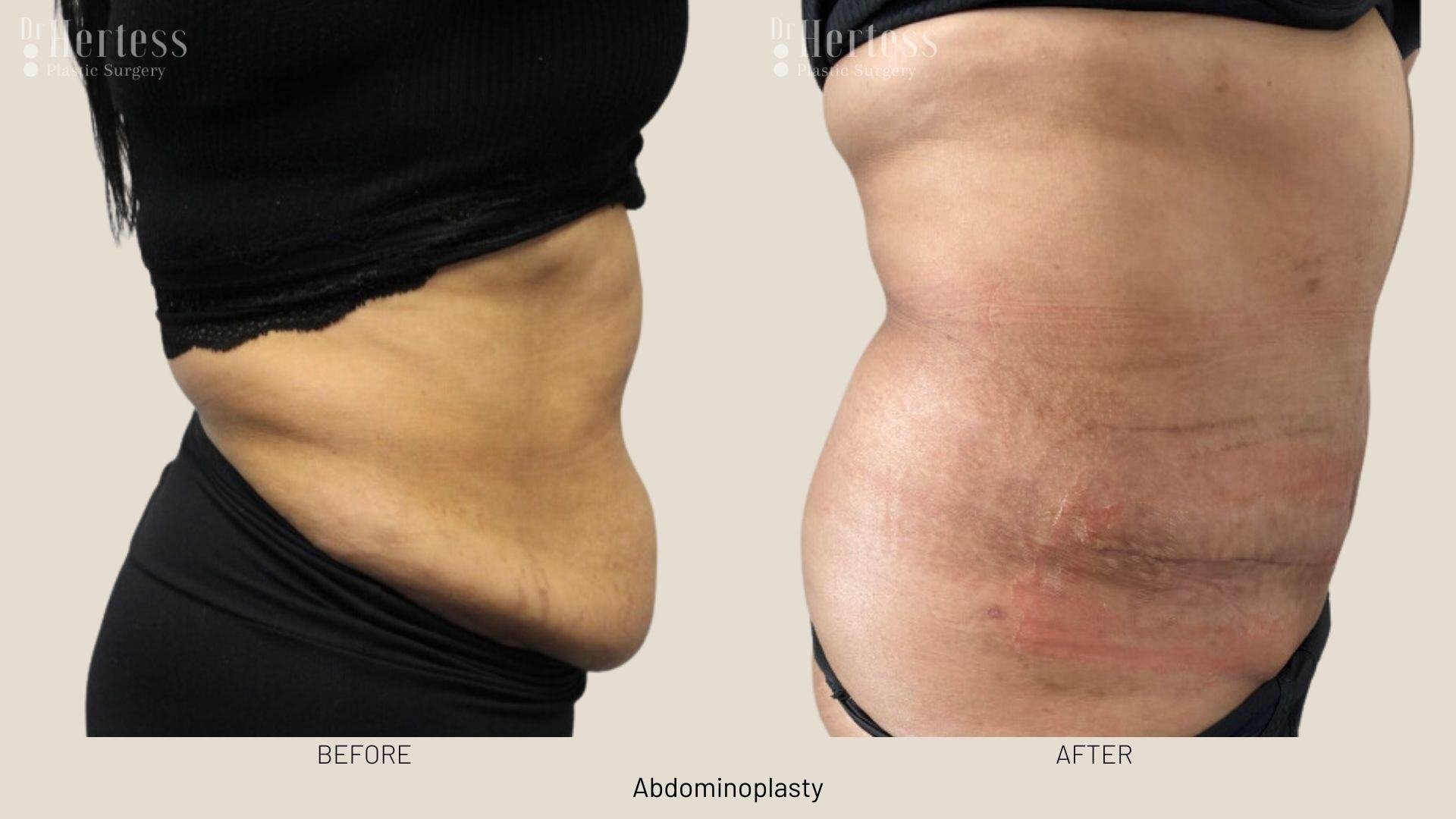 abdominoplasty before and after photos