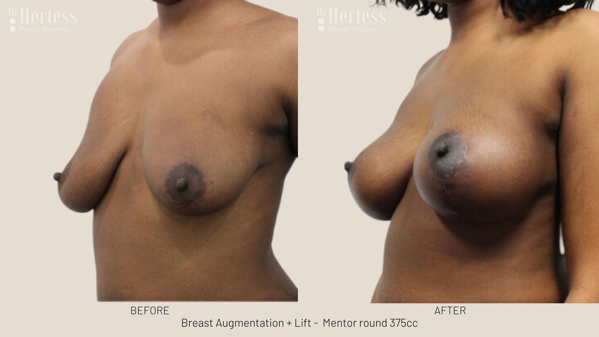 breast aug and lift photos before and after