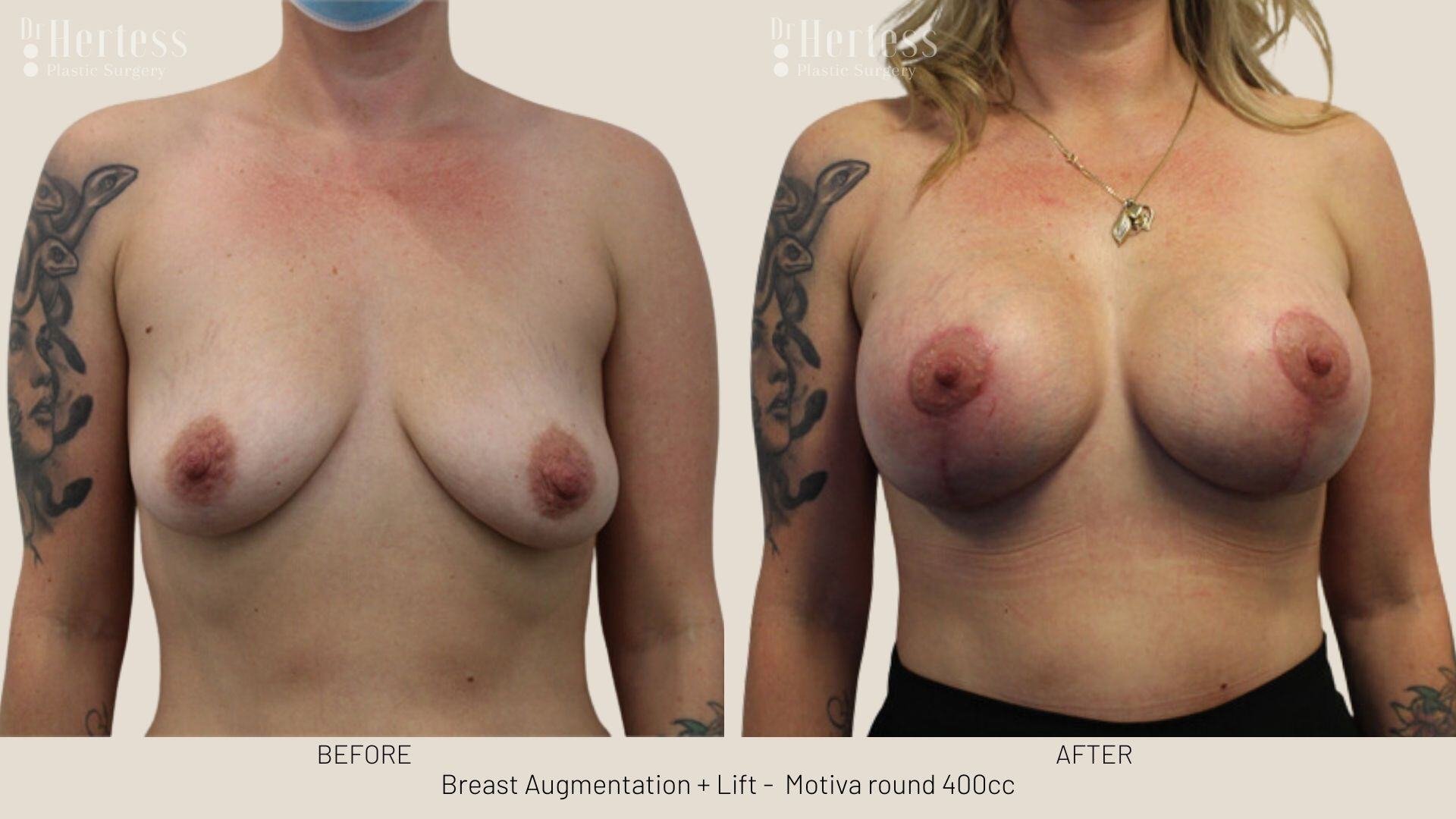 breast aug and lift photos before and after