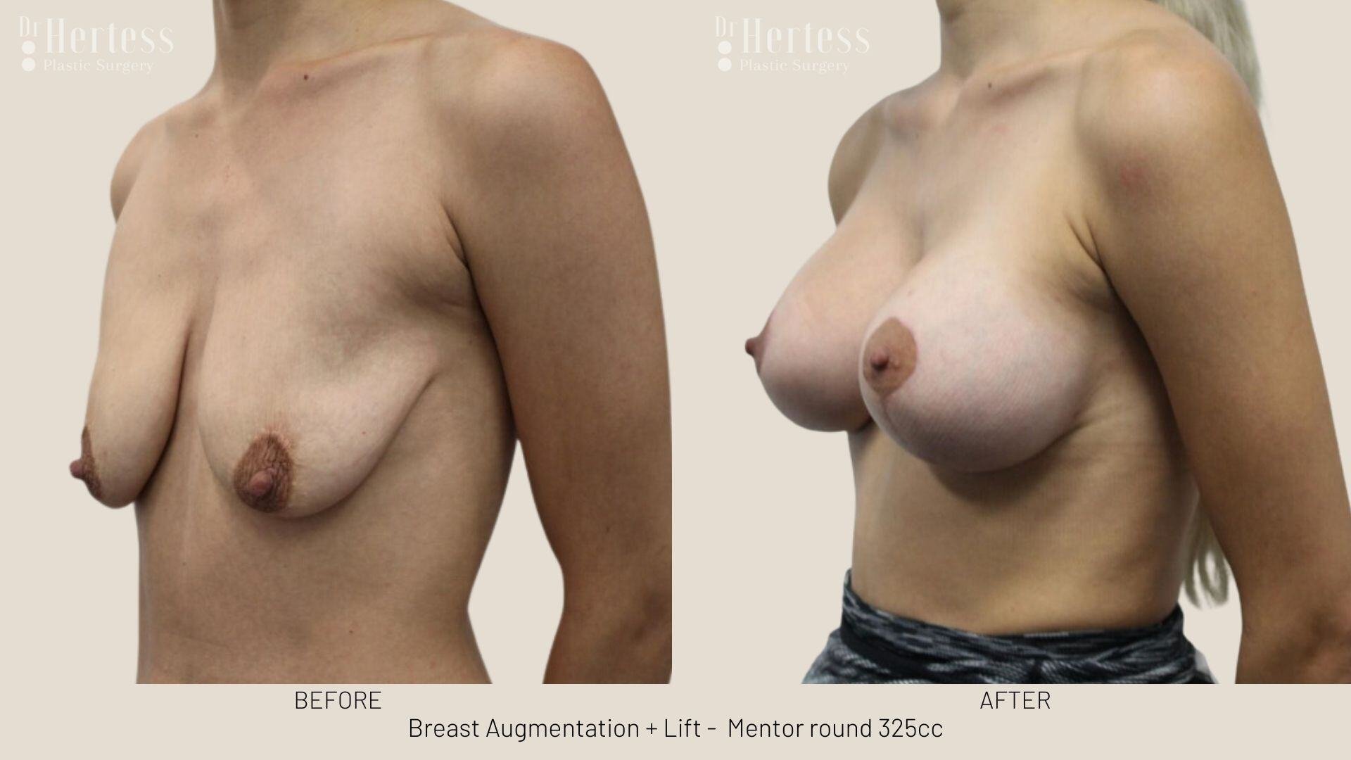 breast aug and lift photos before and after