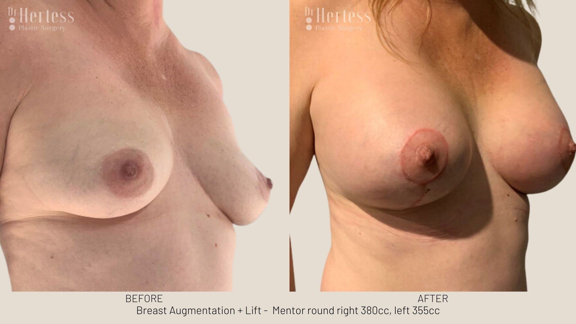 breast aug and lift photos before and after