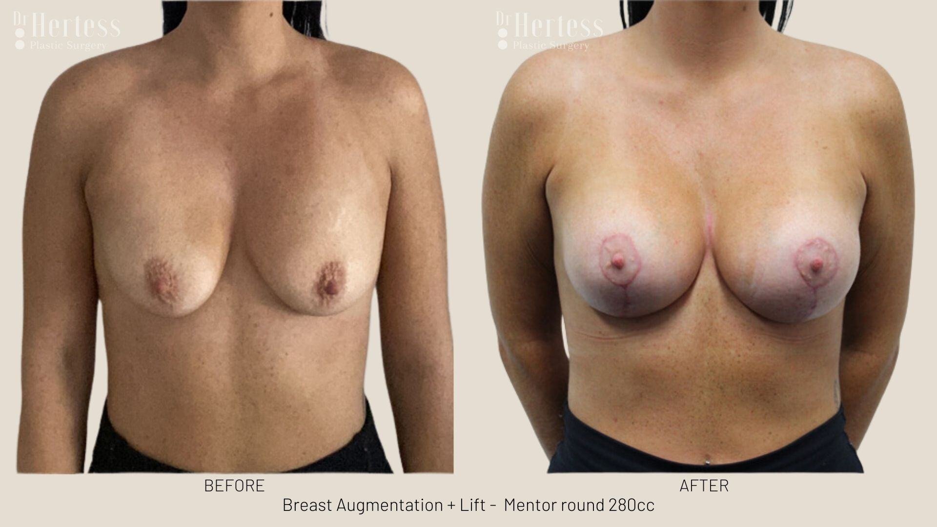 breast aug and lift photos before and after
