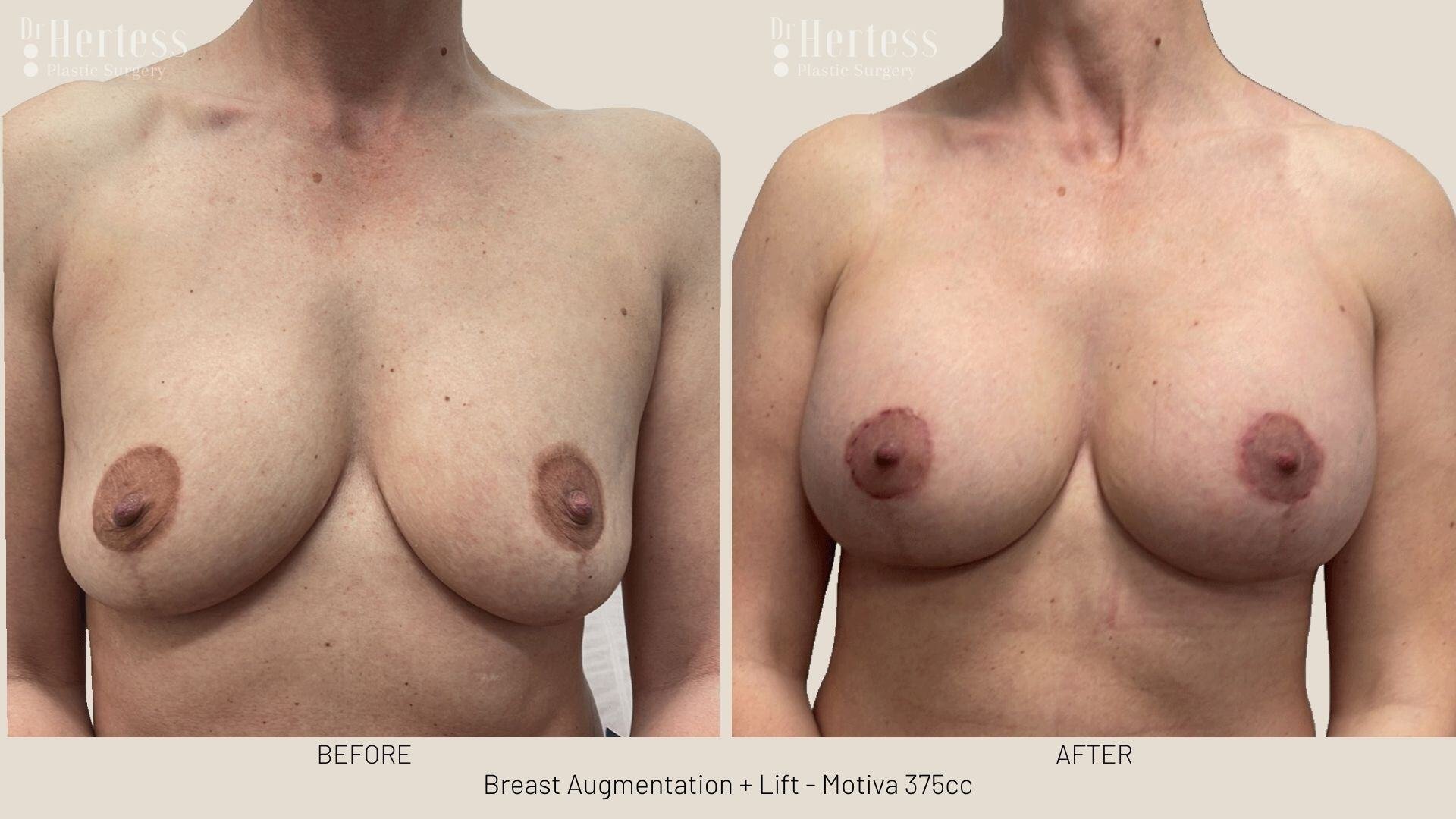 breast implants and lift photos before and after