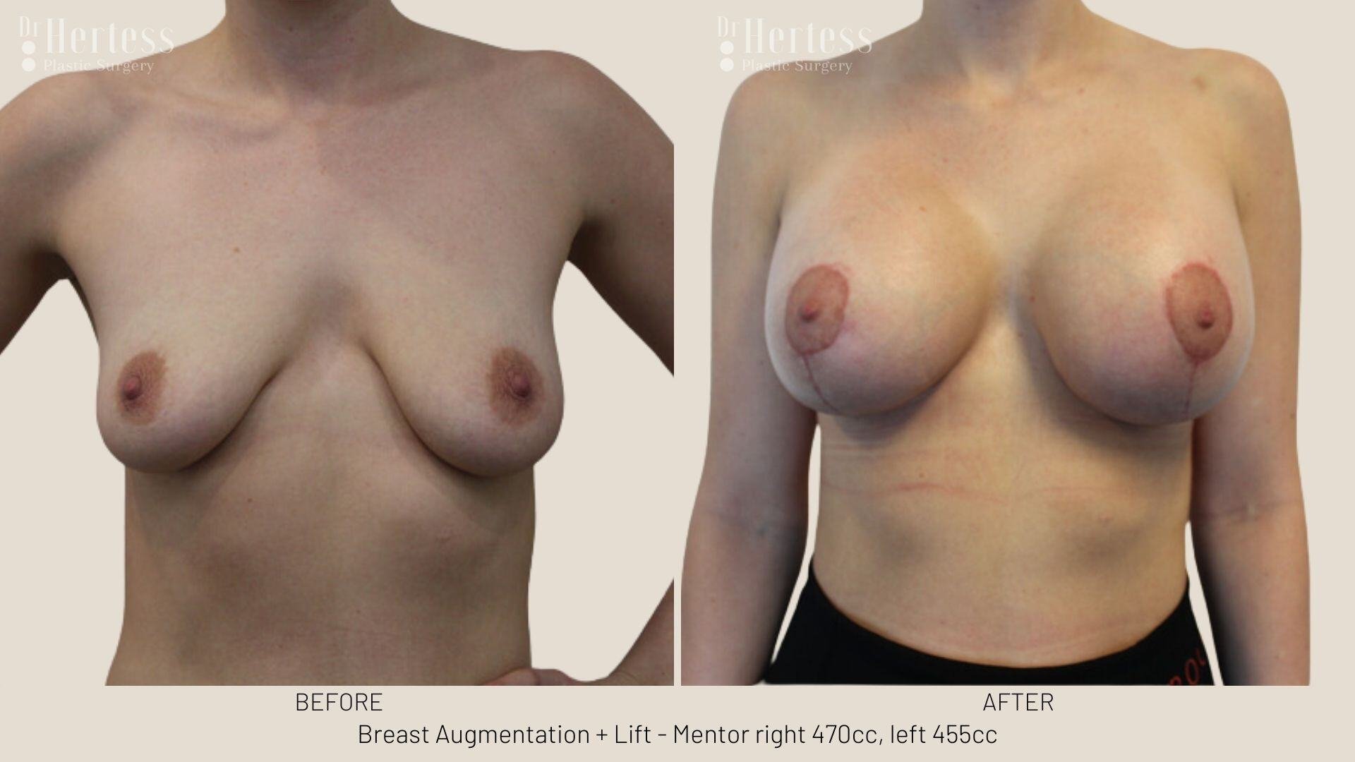 breast implants and lift photos before and after