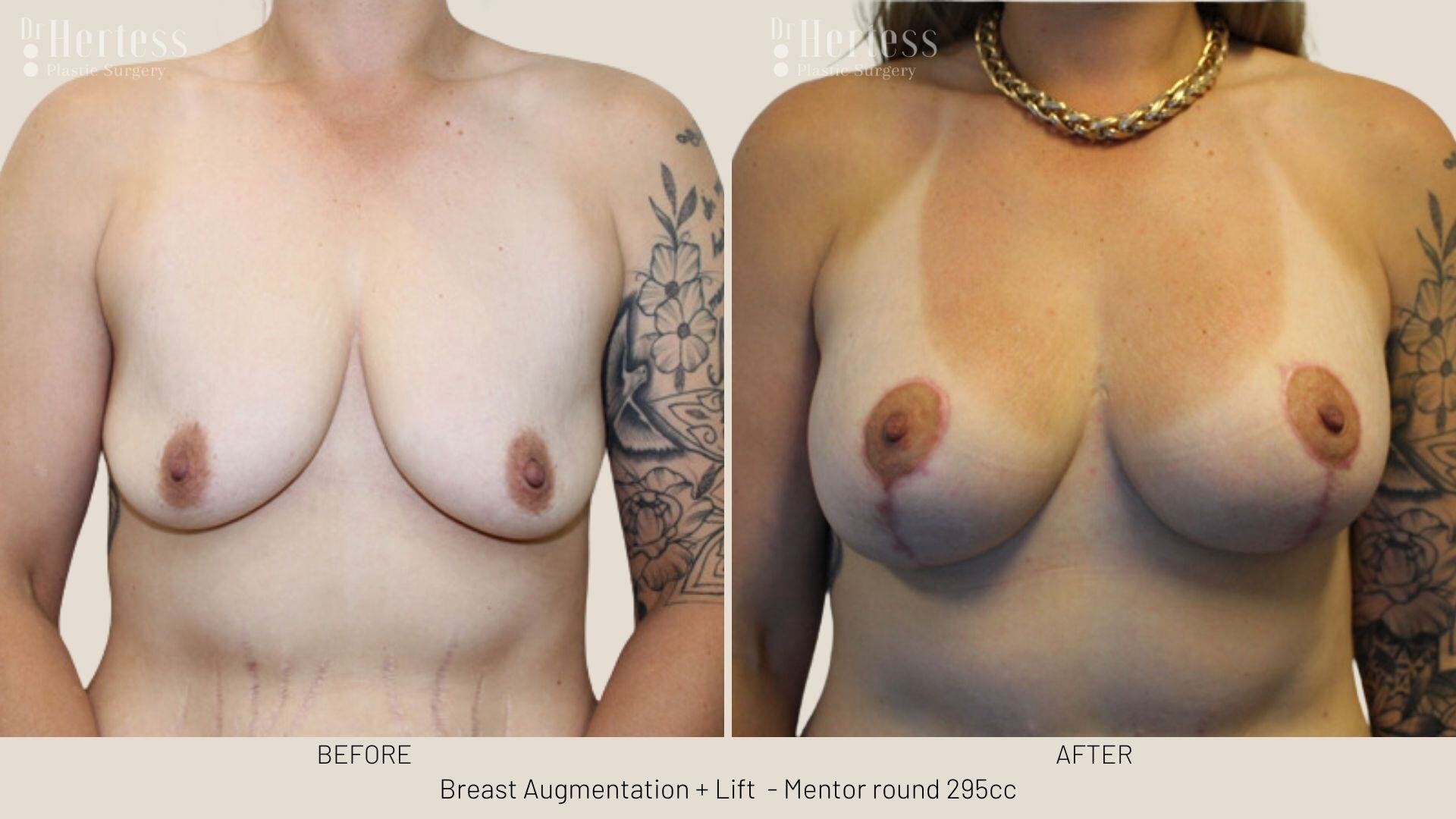 breast implants and lift photos before and after
